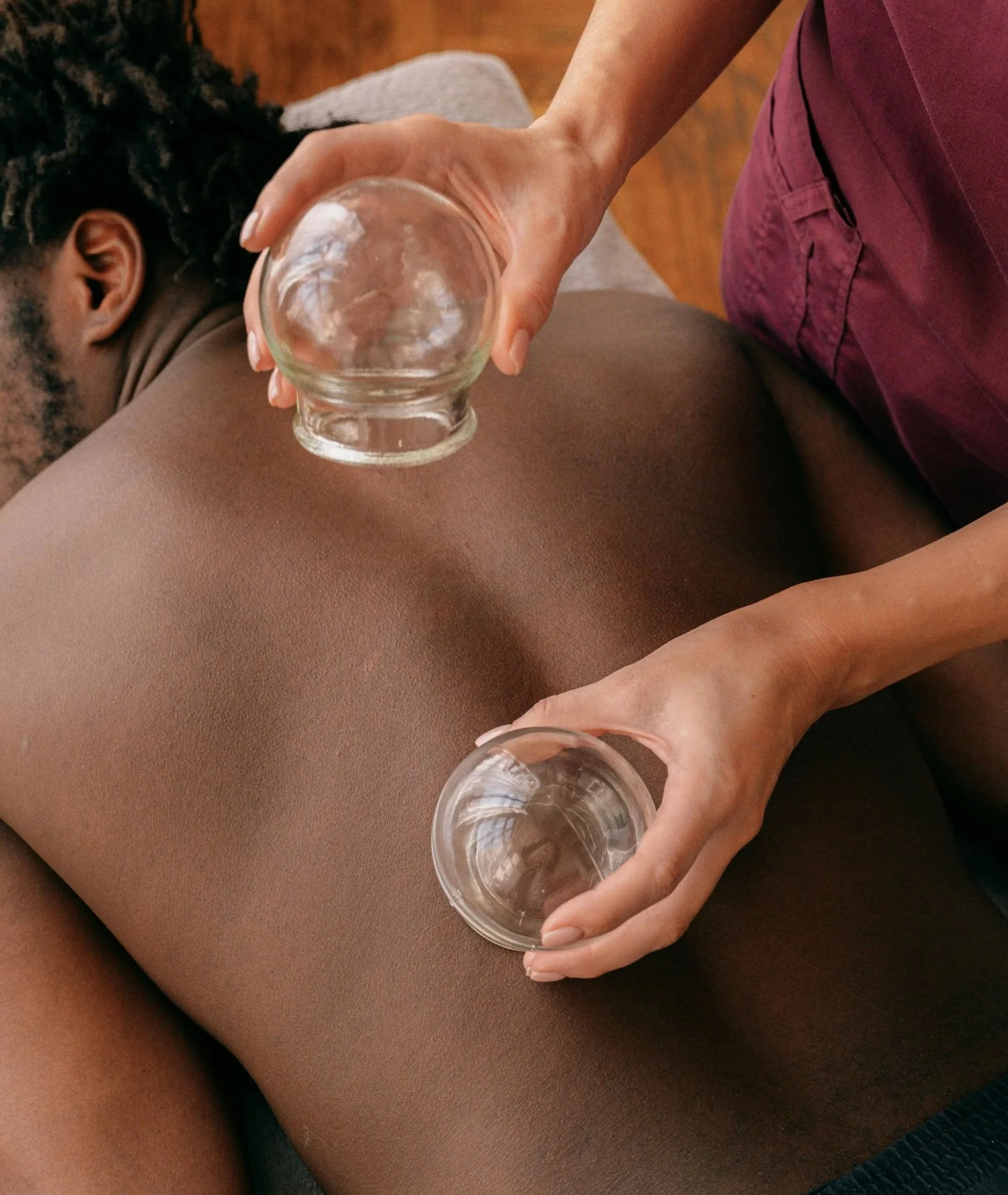 Patient receives cupping from a licensed acupuncturist