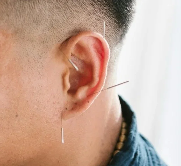 Close-up of a human ear with several acupuncture or acupuncture-like needles inserted at various auricular acupuncture points.
