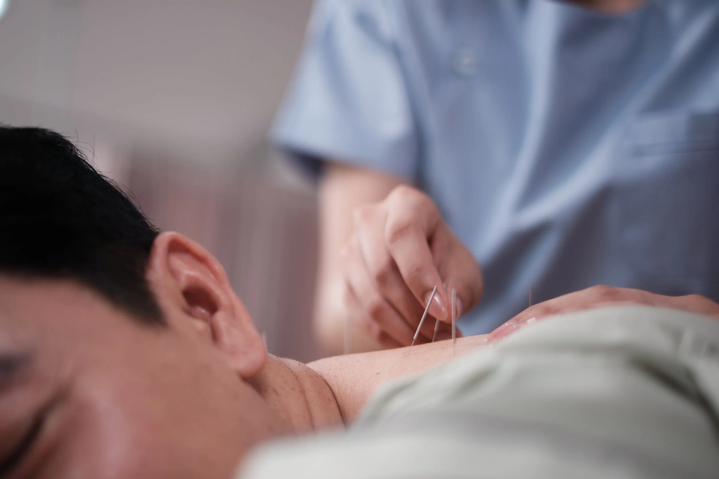 Close-up of a person receiving acupuncture treatment with several thin needles inserted into their skin, while a practitioner in a blue shirt adjusts the needles.