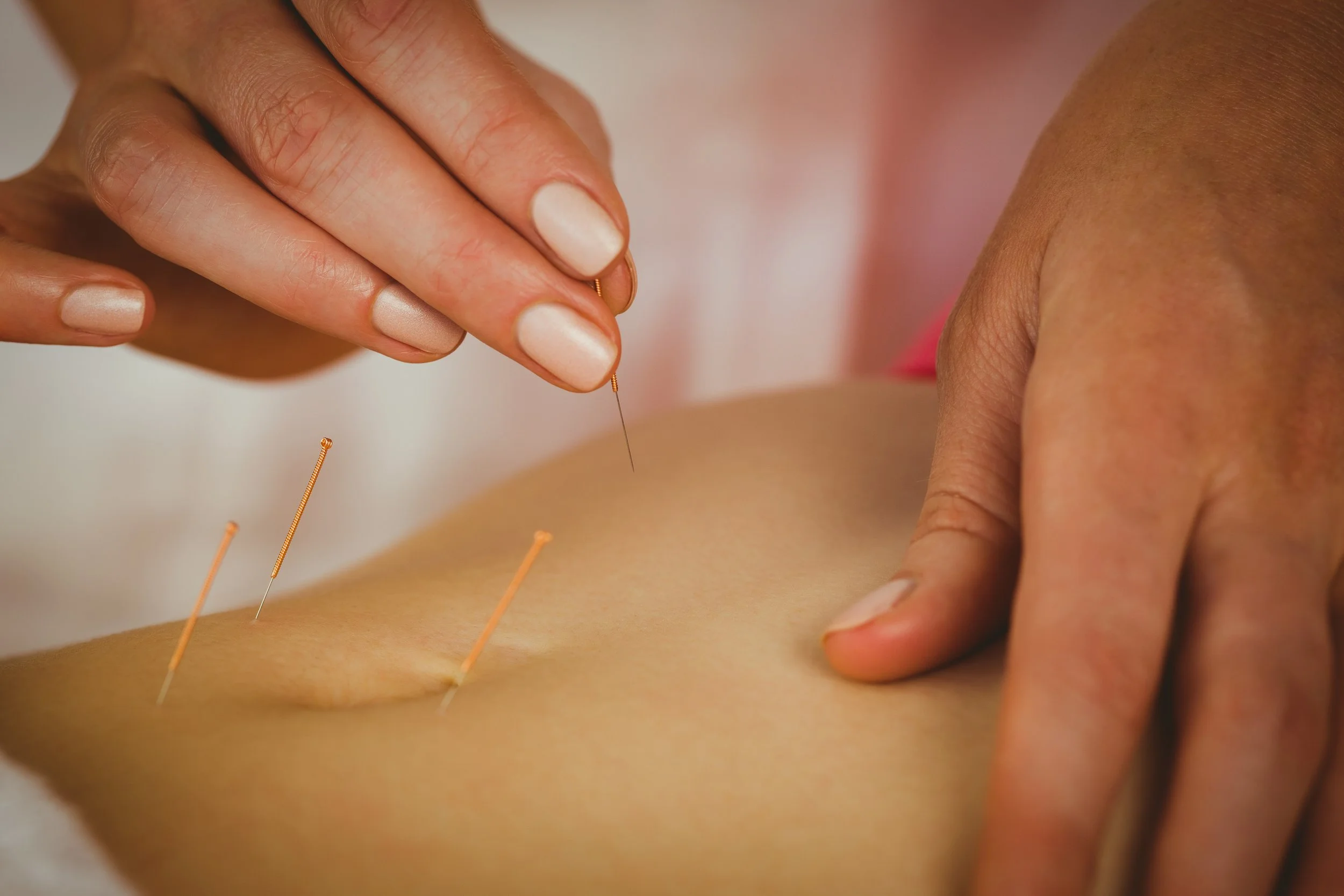 Close-up of a person receiving acupuncture with several thin needles inserted into their back. A practitioner is inserting one needle, holding it delicately between fingers.