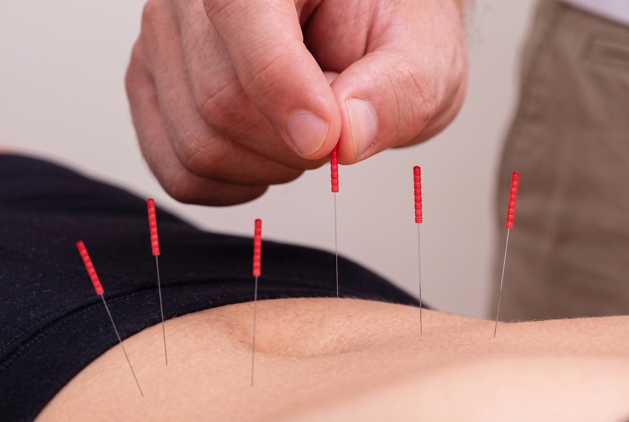 approaches acupuncture