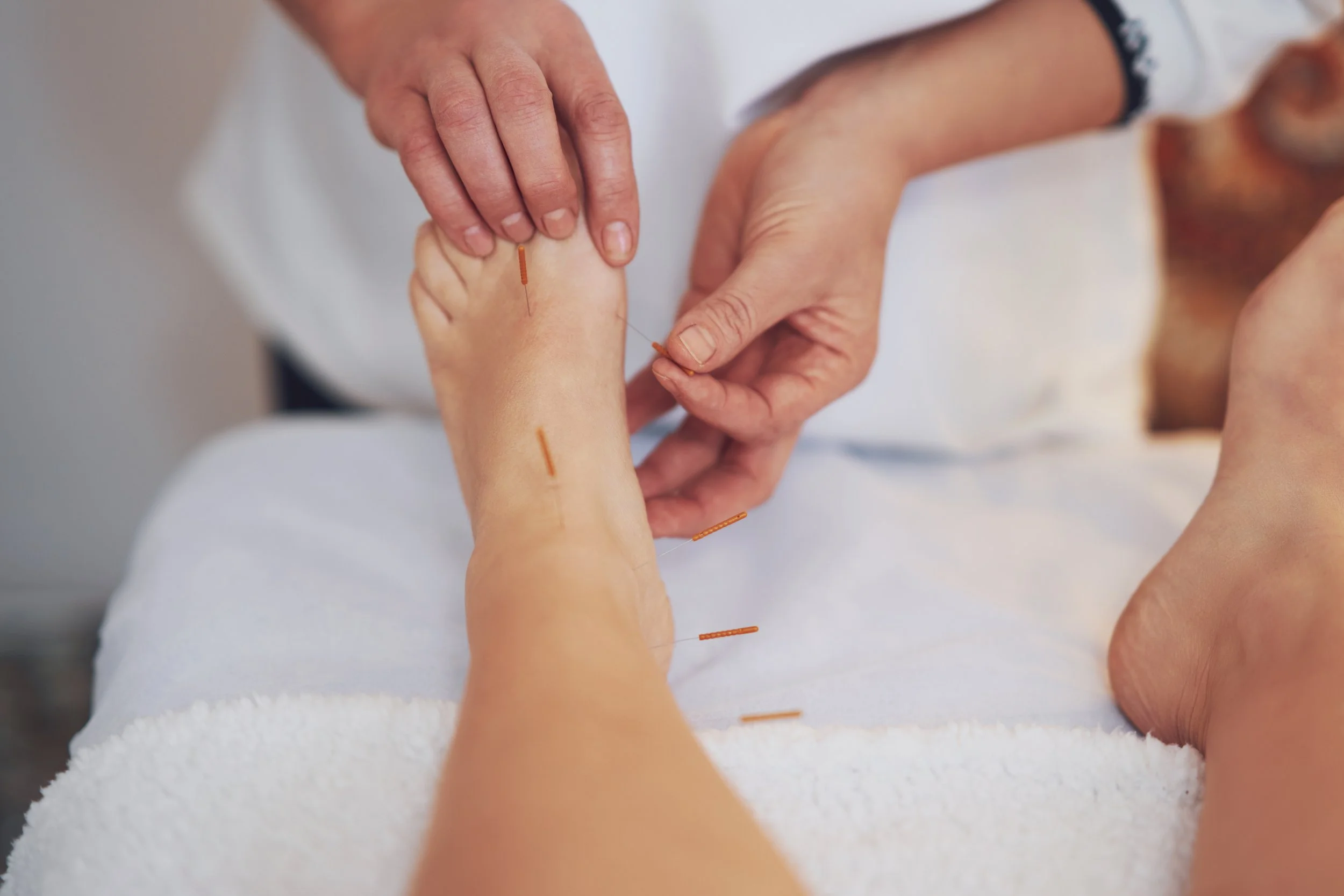 Practitioner inserting acupuncture needles into a person's leg during a treatment session.