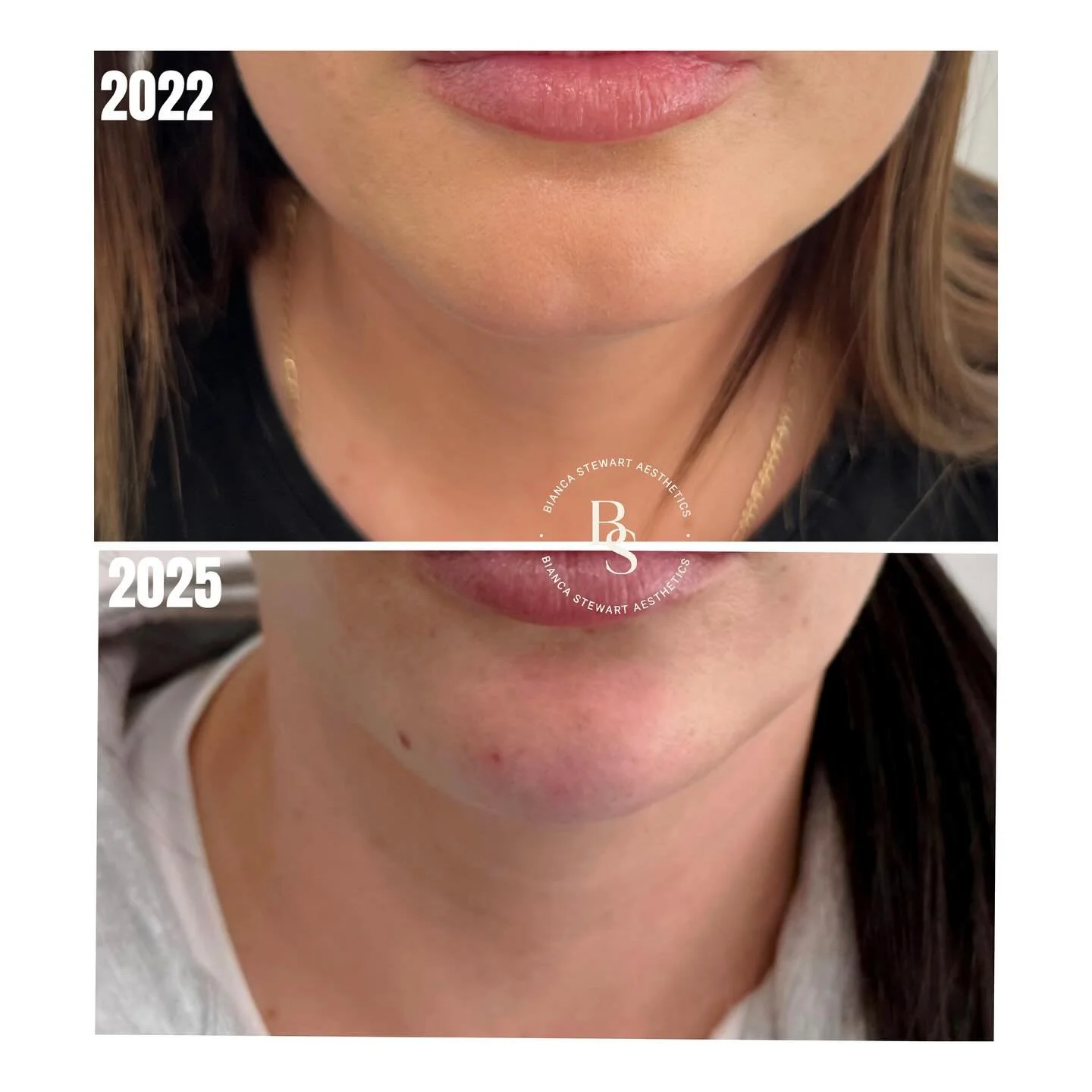 Over time, the muscles of the lower face can change in size and activity. The masseter muscle, which is a primary muscle used for chewing, can become more prominent in some individuals due to natural function, genetics, or habits such as teeth grindi