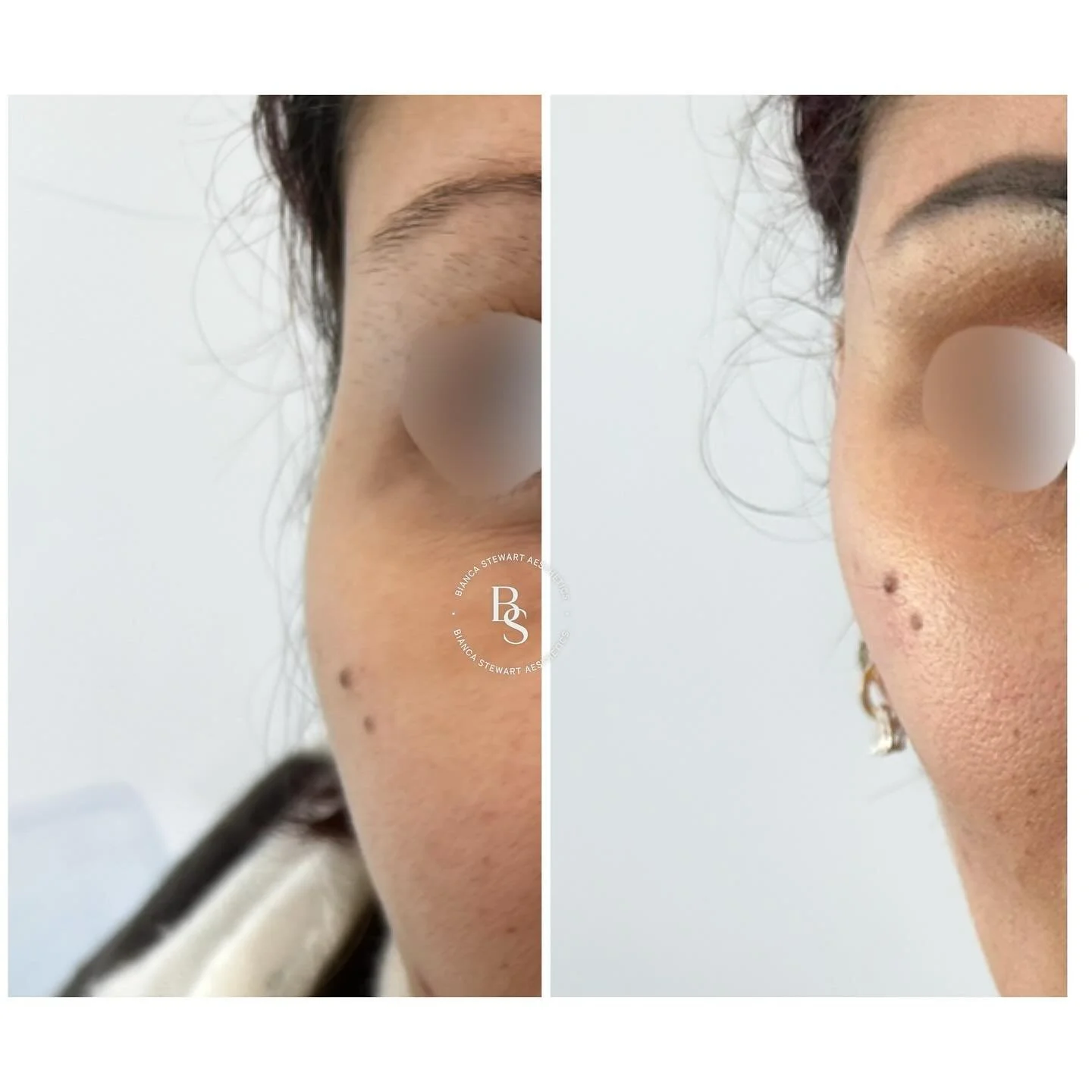 The temples play an important role in the overall shape and balance of the face.
Over time, natural changes can occur beneath the surface, including a reduction in bone support, soft tissue volume, and skin elasticity.

These gradual changes may crea