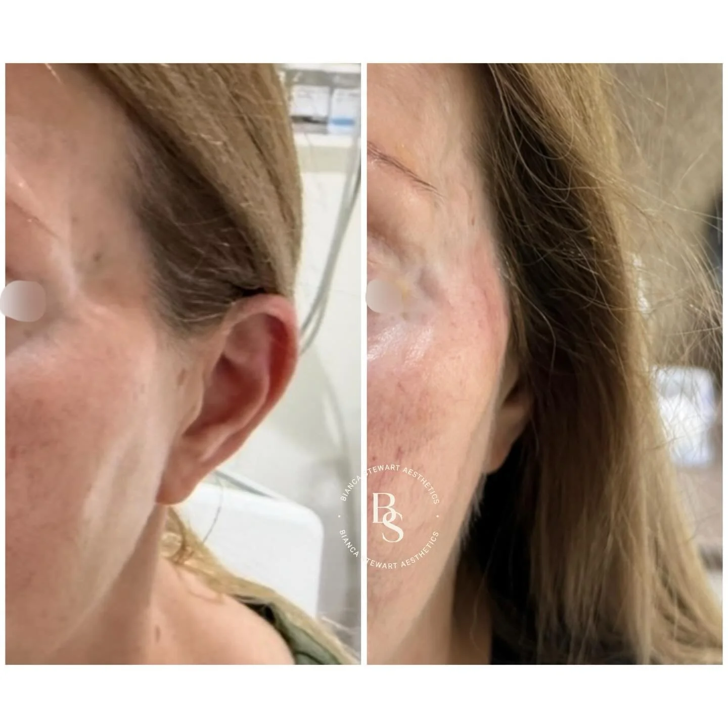 The temples are one of the most overlooked areas when it comes to facial ageing.

Over time, subtle structural changes can occur beneath the surface of the upper face. These may include gradual shifts in fat pads, changes in bone support, and alterat