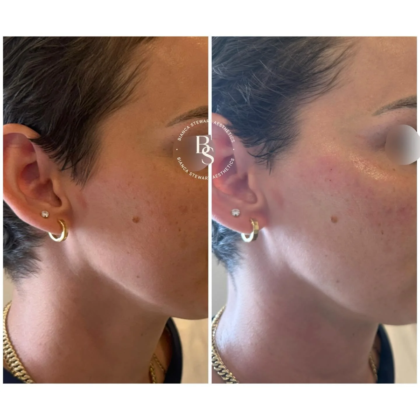 With time, the underlying structures of the face naturally evolve. Gradual changes in bone support, redistribution of fat pads, and reduced collagen production can influence facial volume, contour, and overall skin quality.

Facial structure and skin