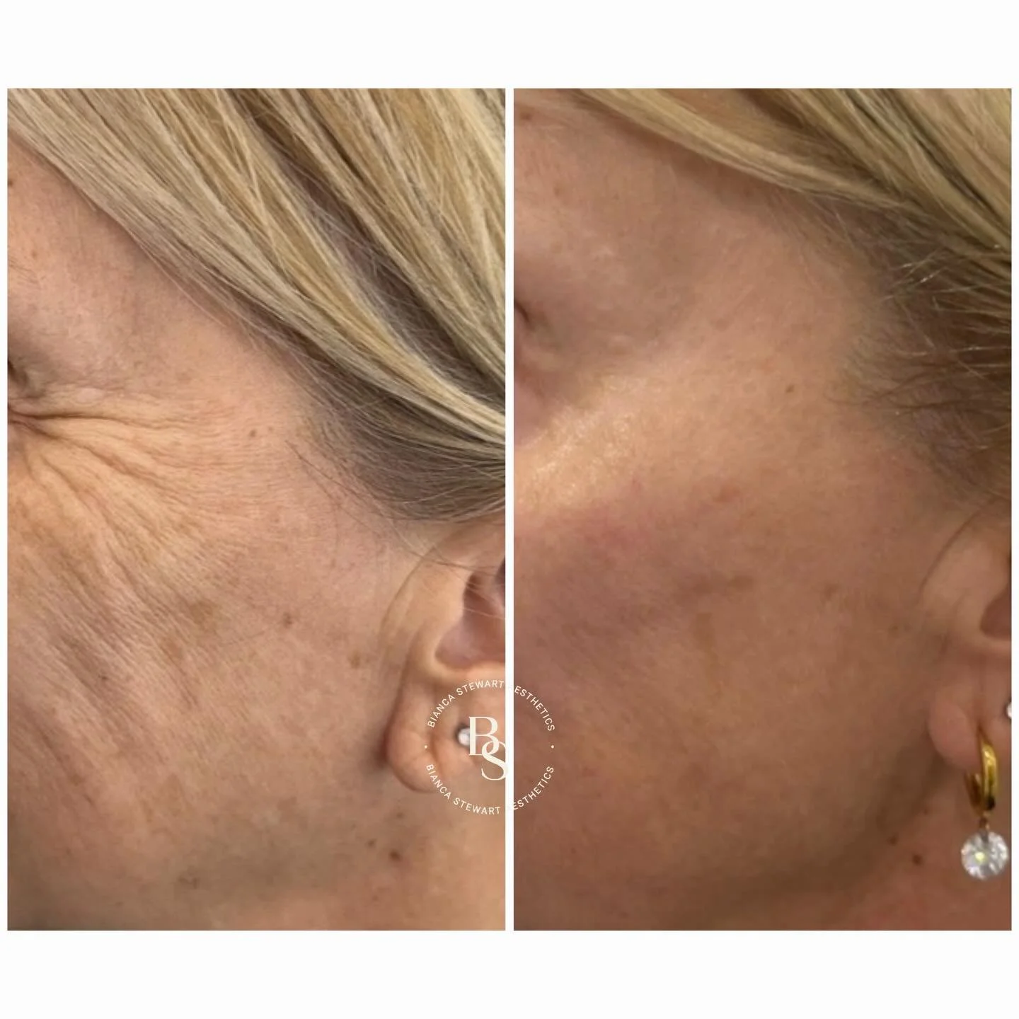 With time, the underlying structures of the face naturally evolve.
Factors such as bone resorption, shifting fat pads, and a gradual reduction in collagen can influence facial balance, volume, and overall skin hydration.

These changes may present as