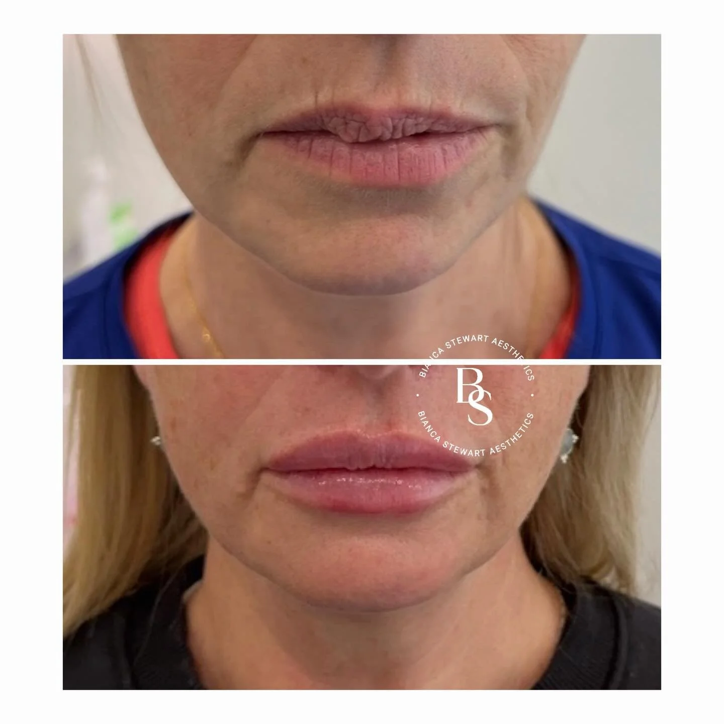 Lip shape, symmetry and movement can be influenced by many factors, including natural anatomy, previous injury and the presence of scar tissue.

Sometimes, previous injury or trauma can result in scar tissue within the lips, which may influence diffe