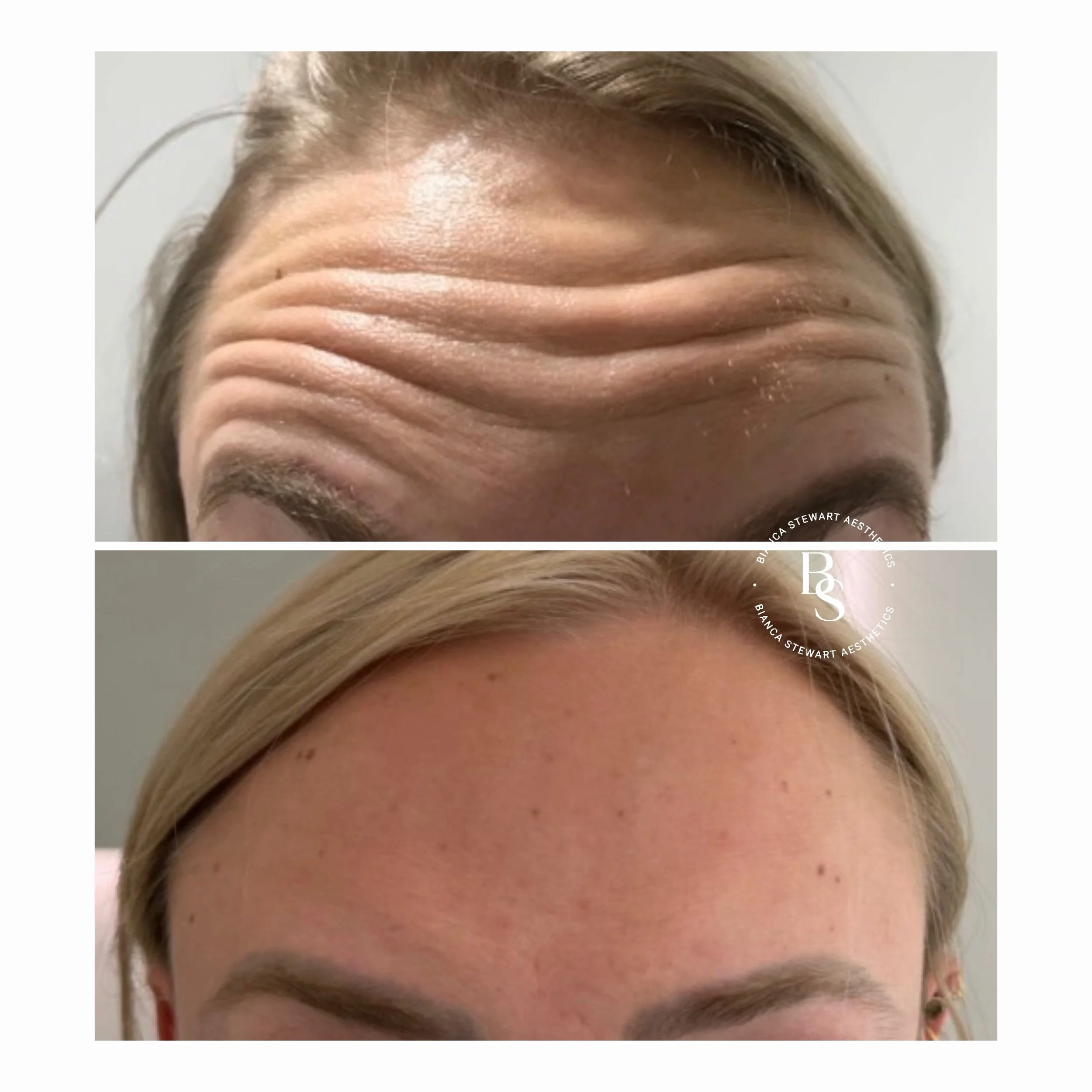 Repetitive facial muscle activity, cumulative sun exposure, and intrinsic ageing contribute to the gradual formation of facial lines. Over time, these changes may become more pronounced, particularly in areas of frequent muscular movement.

A persona