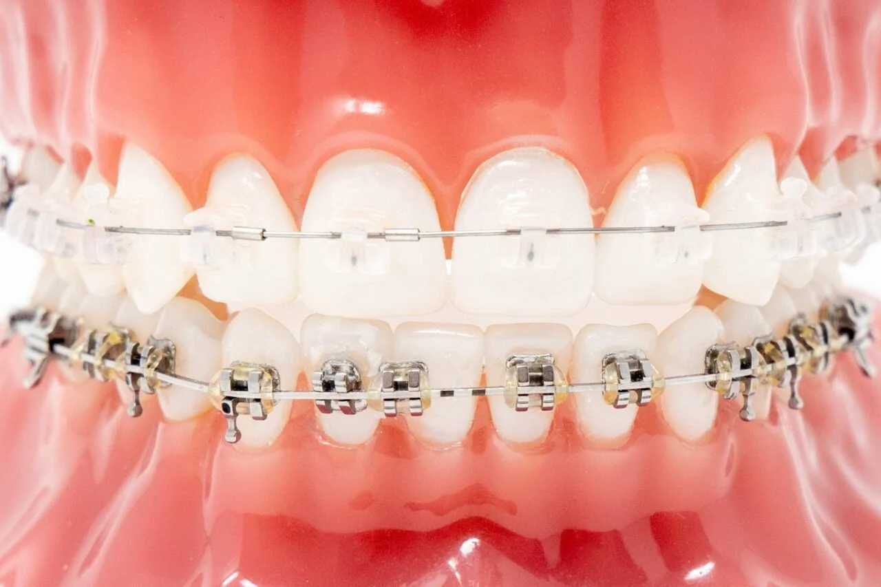 Braces (Metal, Ceramic & Self-Ligating)