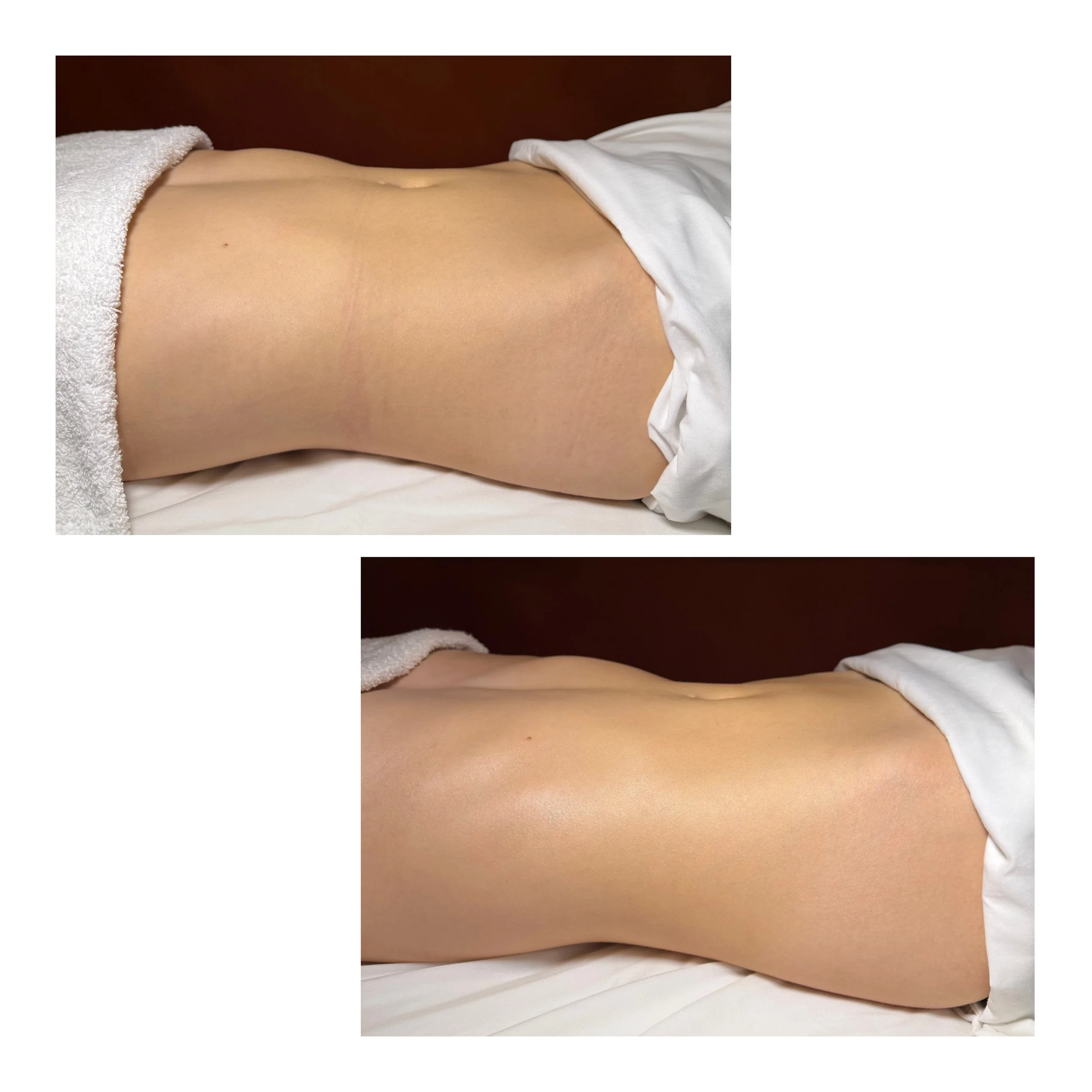 Before and after side-view photos of a client's abdomen following one Brazilian Lymphatic Drainage treatment. The after image shows a flatter, more contoured appearance with reduced bloating and improved waist definition.