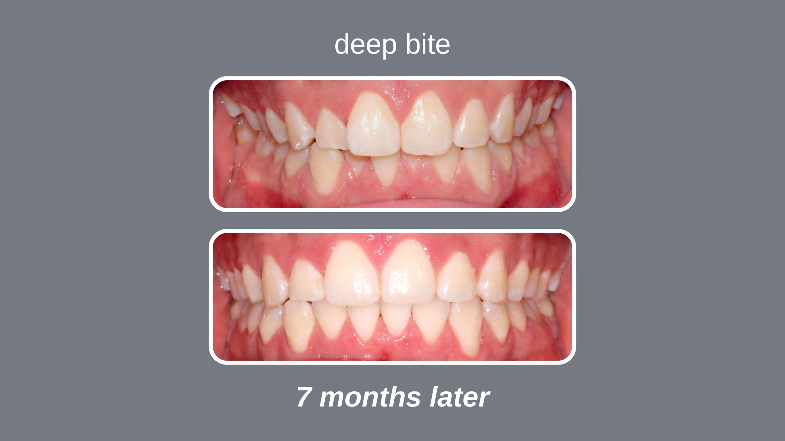 Comparison of teeth before and after treatment, labeled 'deep bite,' showing improvement over 7 months which is used in Avcienna Dental