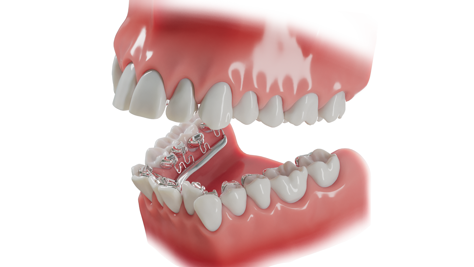 A study model of teeth showing orthodontic braces on the lower teeth with brackets and wires which is used in Avcienna Dental