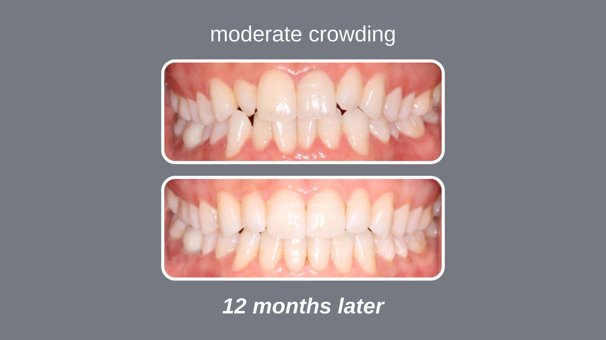 Comparison of teeth before and after 12 months, showing oral health improvement with less crowding in the lower teeth in the after image which is used in Avcienna Dental