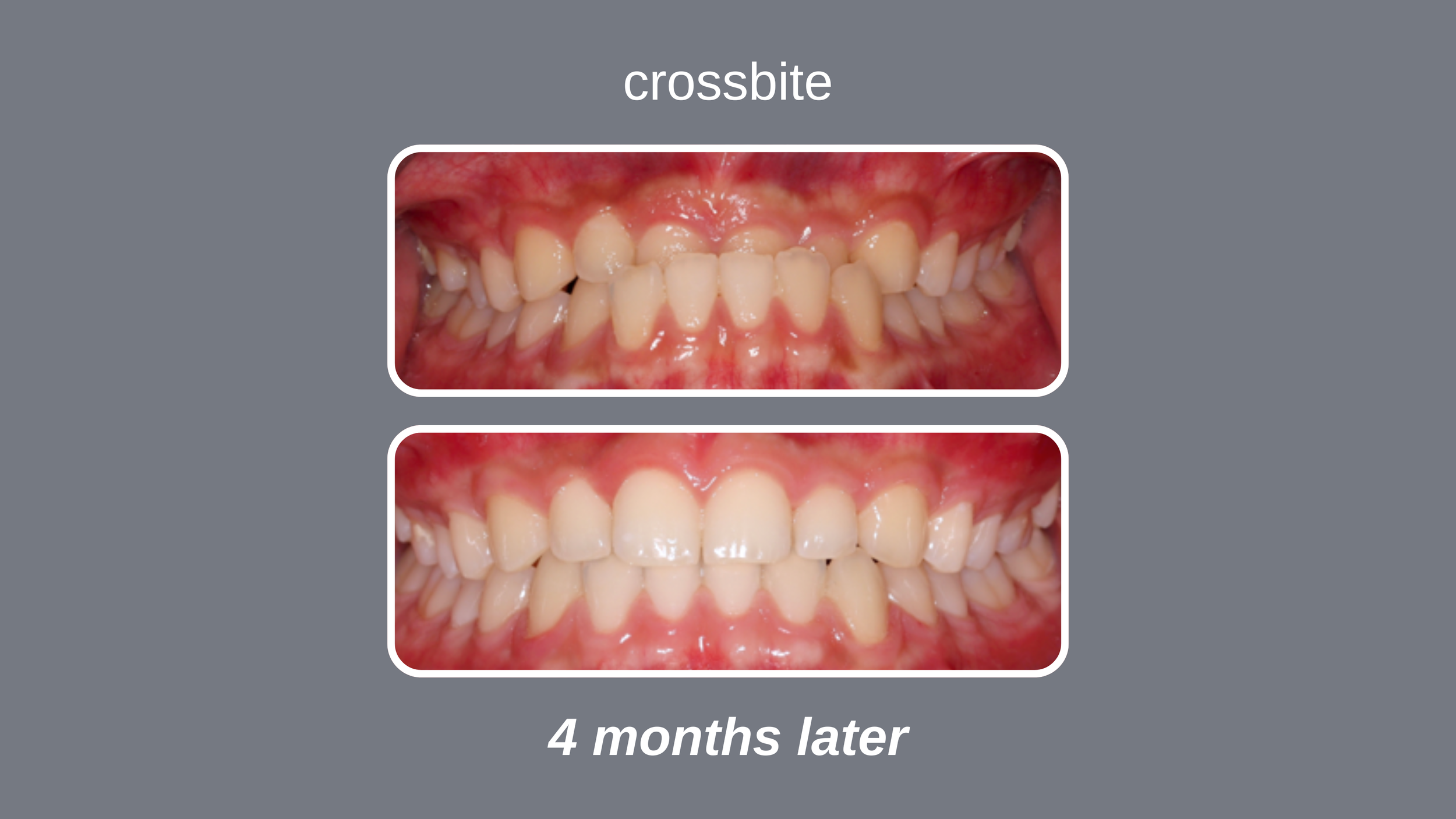 Comparison of two sets of teeth, showing improvement over 4 months, with the label 'crossbite' and the caption '4 months later' which is used in Avcienna Dental