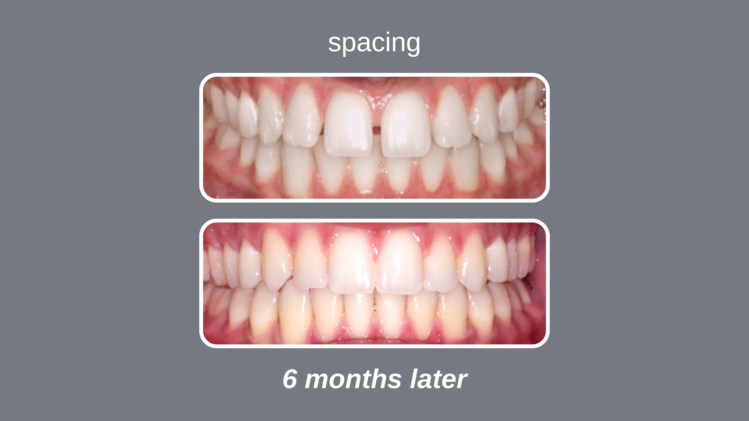 Comparison of teeth before and after 6 months of orthodontic treatment showing improved alignment and spacing which is used in Avcienna Dental