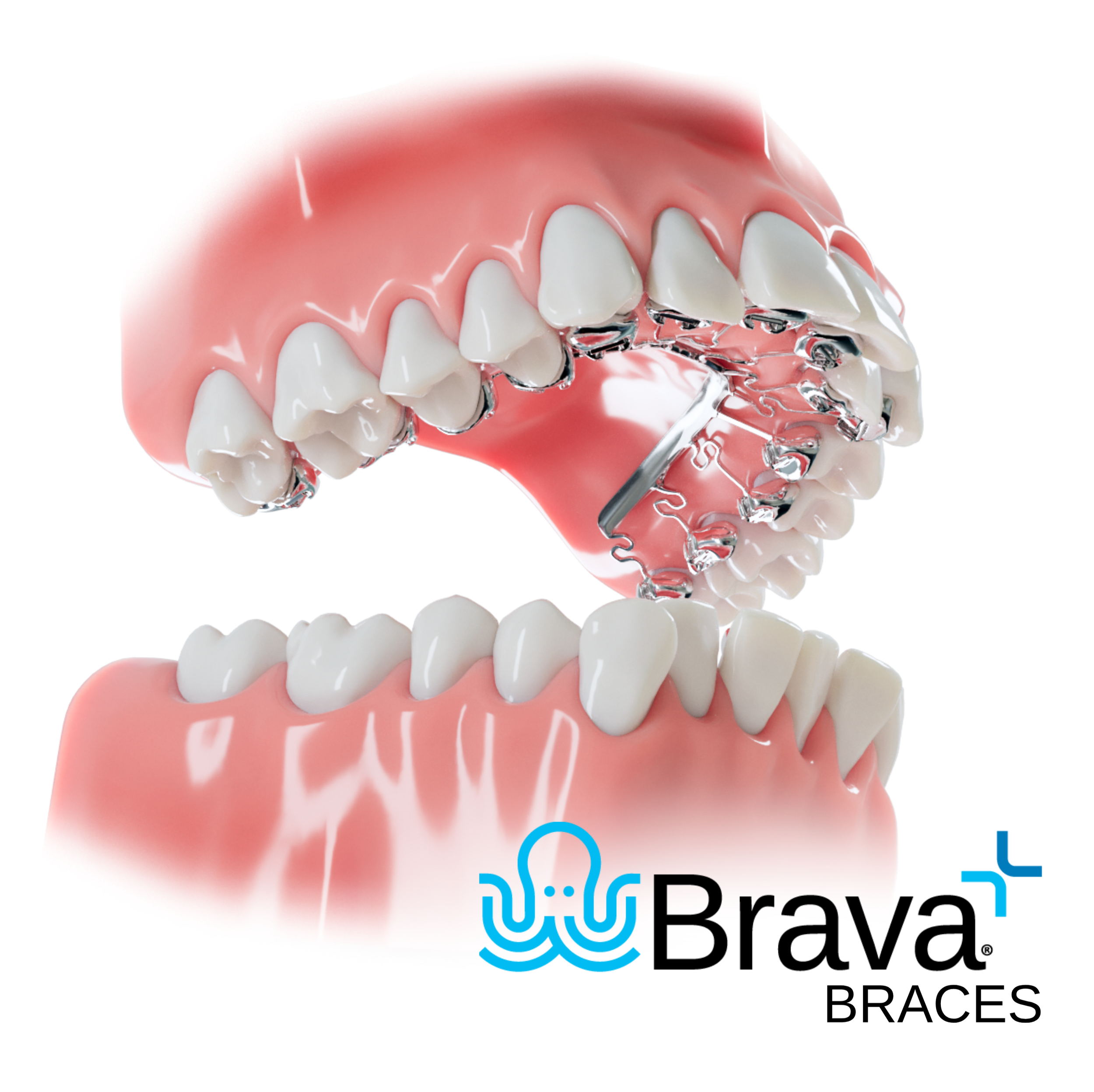 A digital illustration of an upper and lower set of teeth with braces, showing the wires and brackets attached to straighten teeth. The Brava Braces logo is visible in the bottom right corner which is used in Avcienna Dental