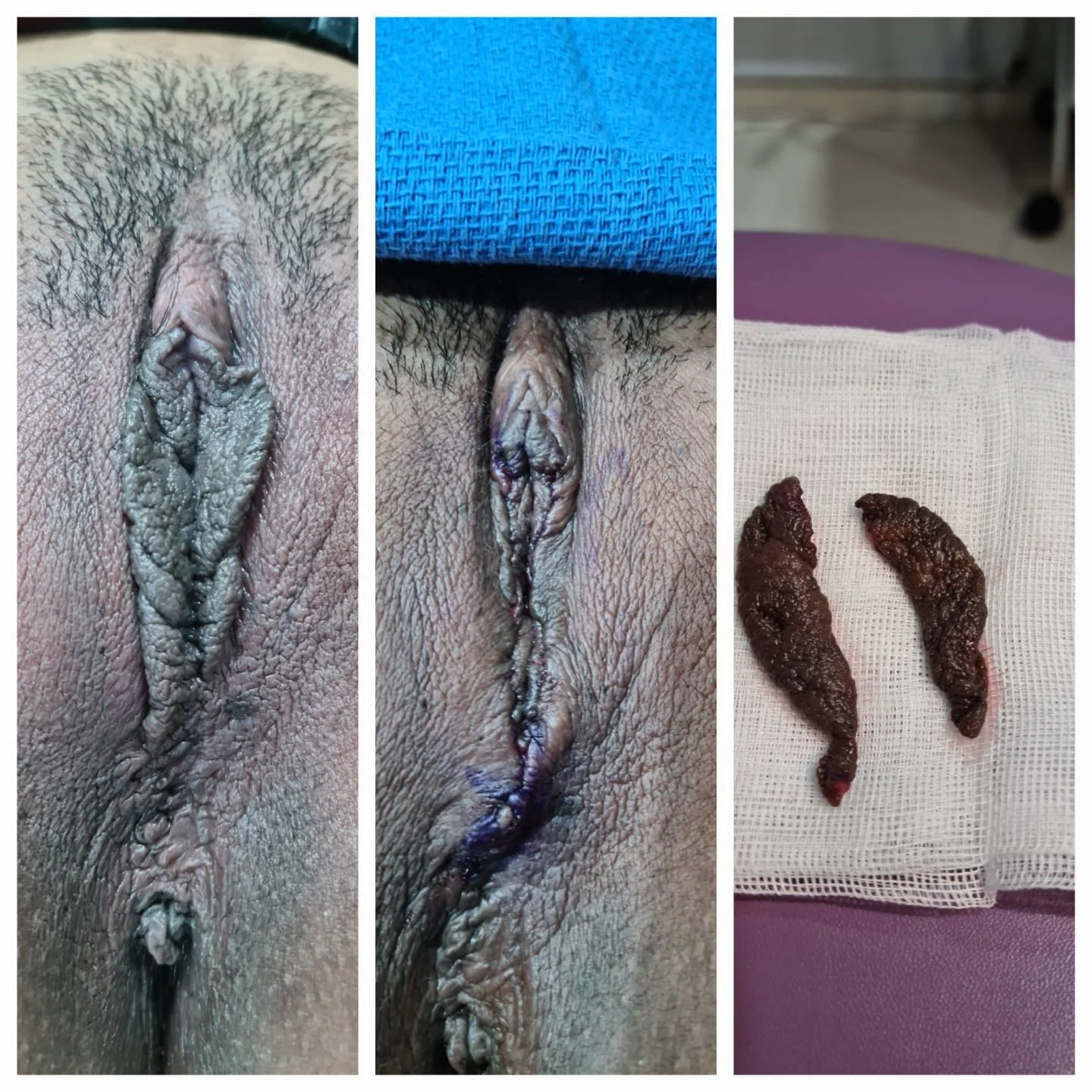Labioplastía