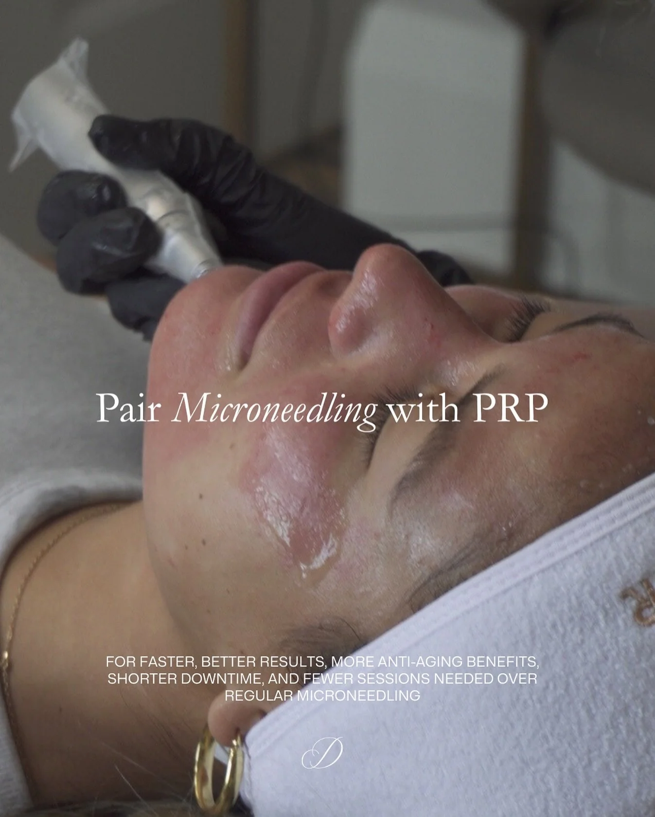 Microneedling helps with those who face concerns like fine lines, acne scars, enlarged pores, uneven texture, or dull skin&hellip;

But when you pair microneedling with PRP (Platelet-Rich Plasma), you take your results even further. 

PRP uses the gr