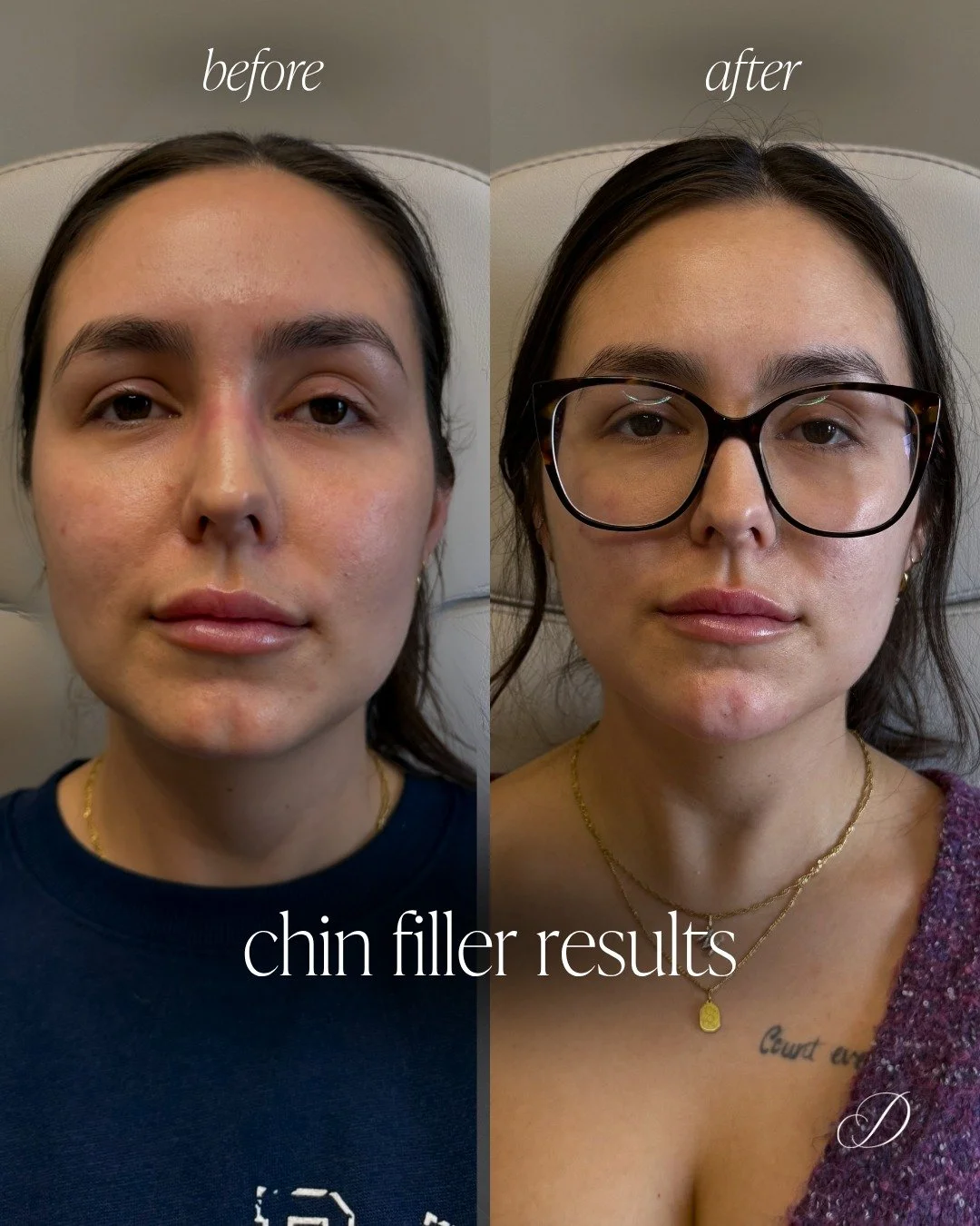 For this client, we created a softer, more feminine lower face structure while keeping her natural chin dimple.
Every treatment starts with a thorough assessment-what you&rsquo;d like to change, and just as importantly, what you don&rsquo;t. This bea