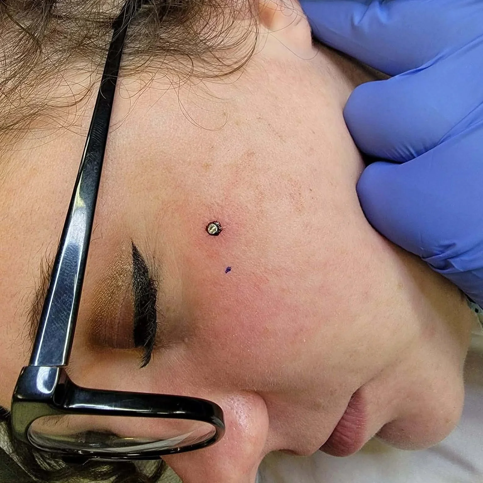 The side of a woman's face with a dermal anti-eyebrow piercing.