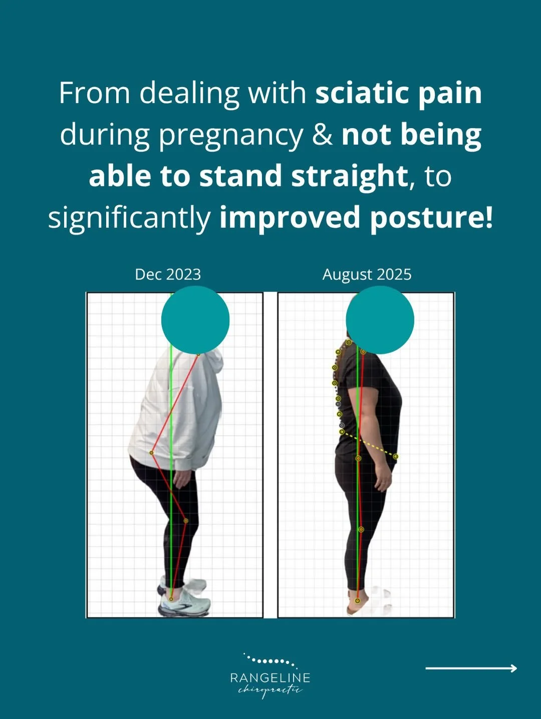 When this patient first walked through our doors in December 2023, she couldn&rsquo;t stand up straight. 
⠀⠀⠀⠀⠀⠀⠀⠀⠀
🤰🏼 Right sciatic pain during pregnancy had taken over; every movement was a reminder of the discomfort she was carrying.
⠀⠀⠀⠀⠀⠀⠀⠀⠀
W