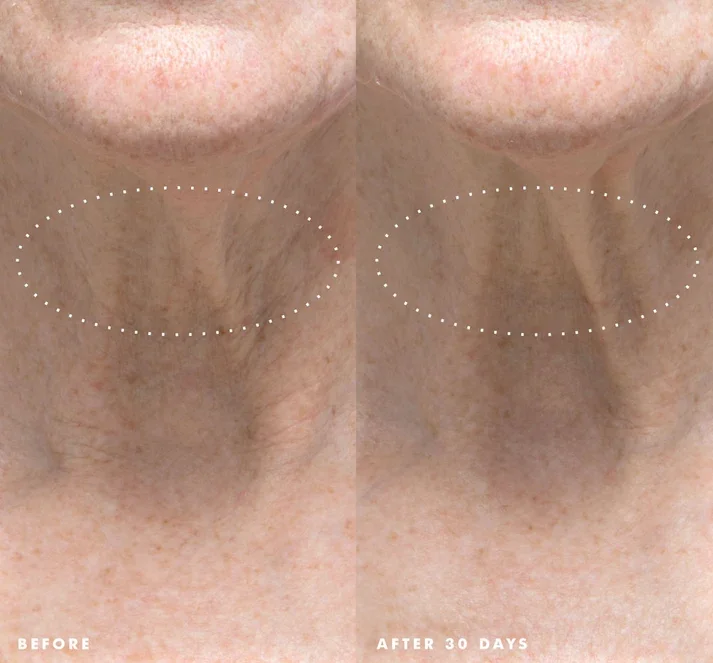 ClinicalInset-NecksLevelSmooth2.webp