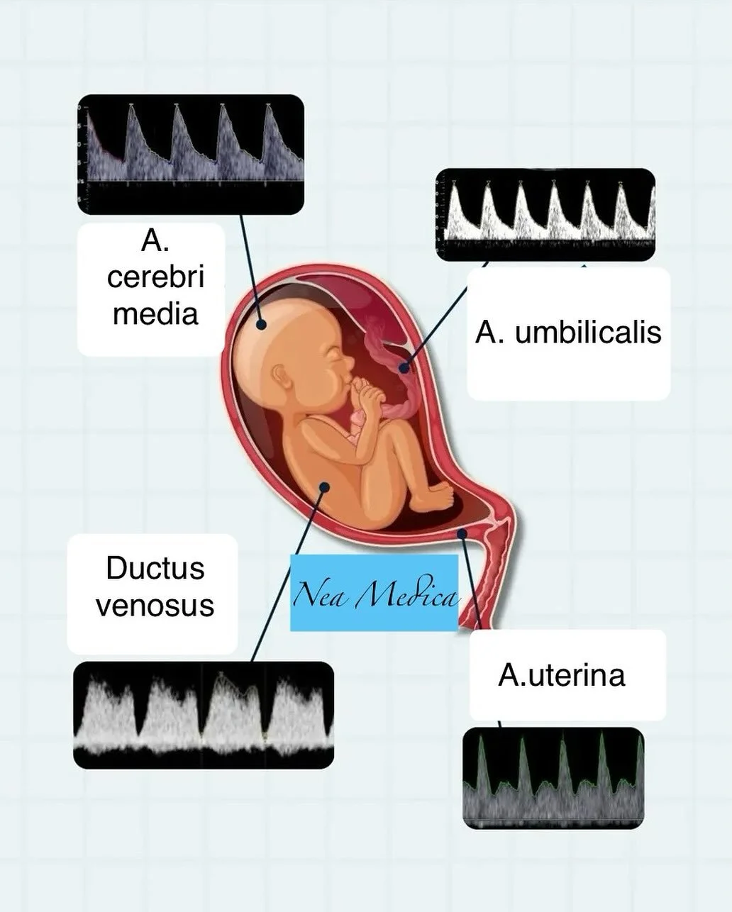Važni parametri protoka krvi kod mame i bebe ( utero-feto-placentna cirkulacija) koje kontroli&scaron;emo tokom trudnoće. 
Pregled u ordinaciji Nea Medica Vam pruža kompletan pregled u trudnoći po svetskim standardima.
Zakažite pregled pozivom na bro