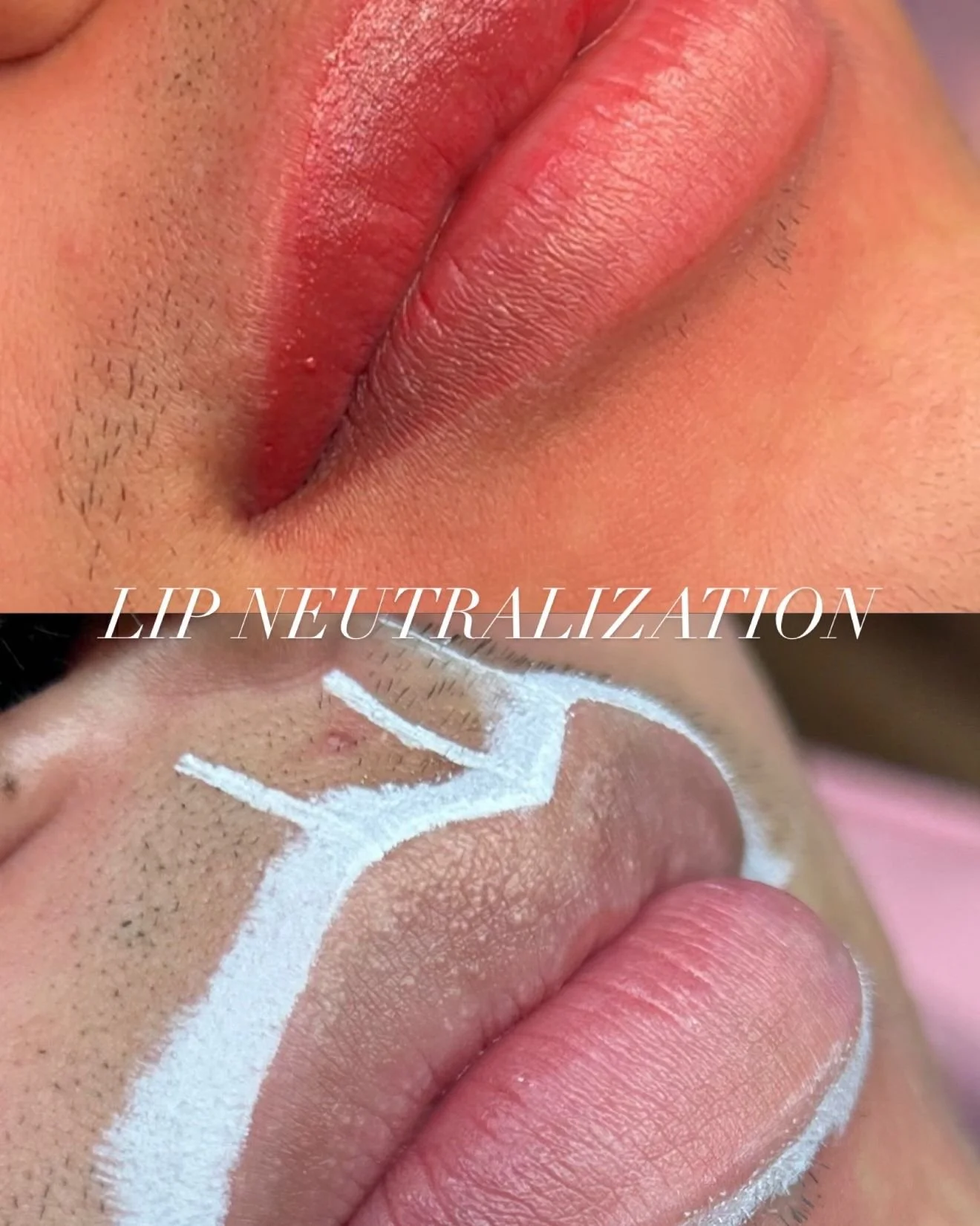 Neutralize, Define, &amp; Enhance 💋✨
Lip neutralization is all about bringing balance back to the natural tone of the lips while creating a more even, beautiful canvas. The goal? Healthy-looking, balanced lips with a soft, enhanced finish!

Every li