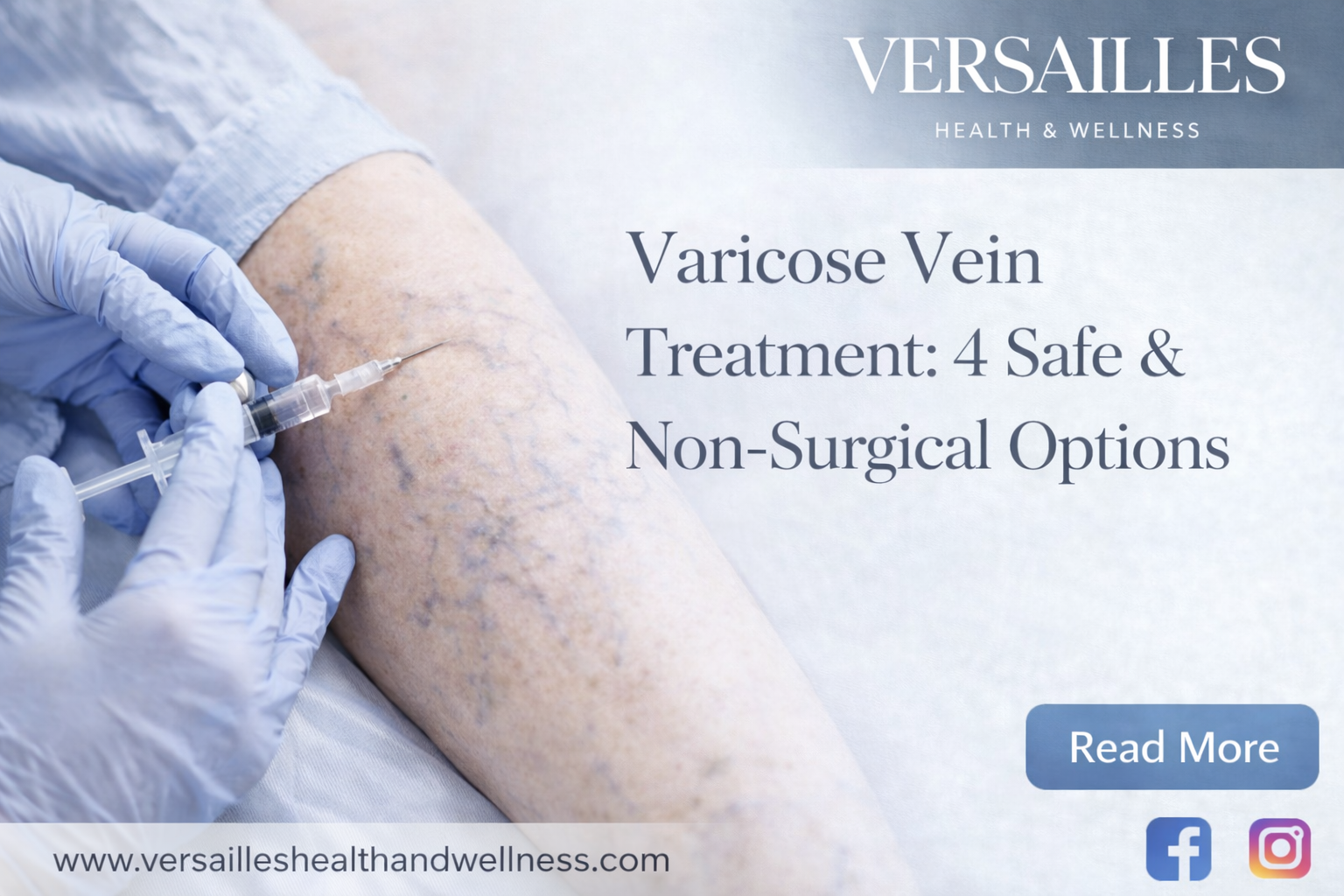 Varicose Vein Treatment: 4 Safe &amp; Non-Surgical Options