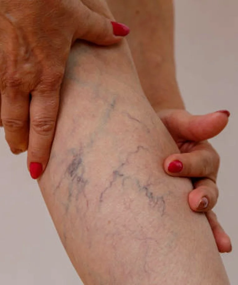 vein solutions in dallas texas.jpeg