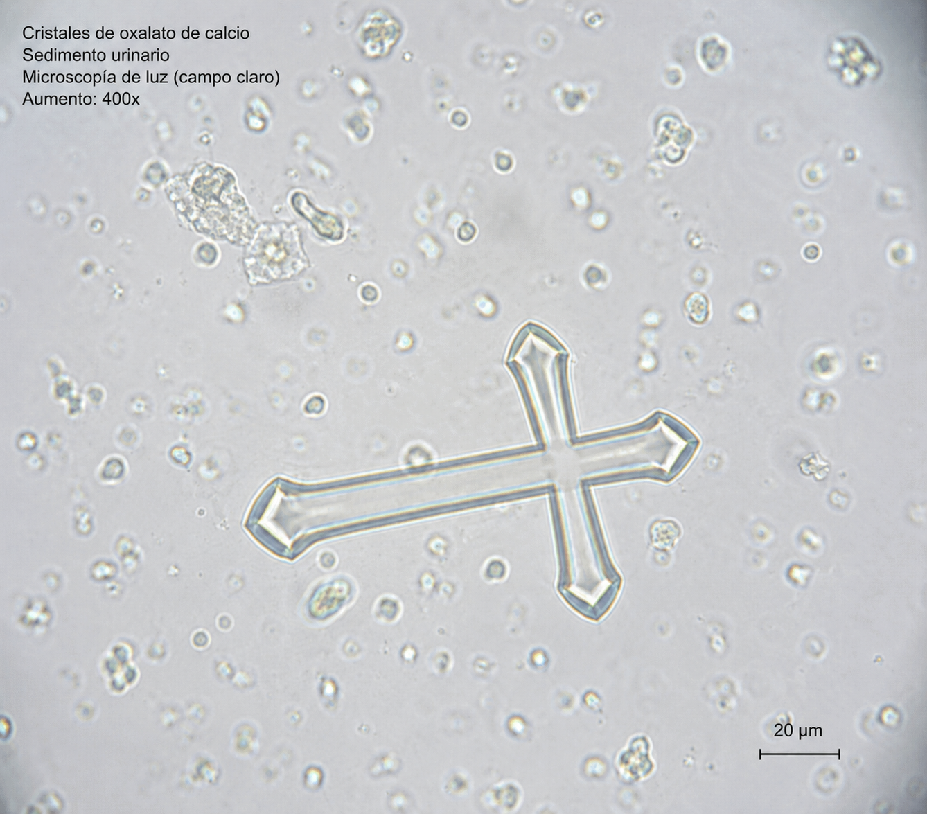 Cristales de oxalato de calcio observados en muestra fresca bajo microscopía de luz