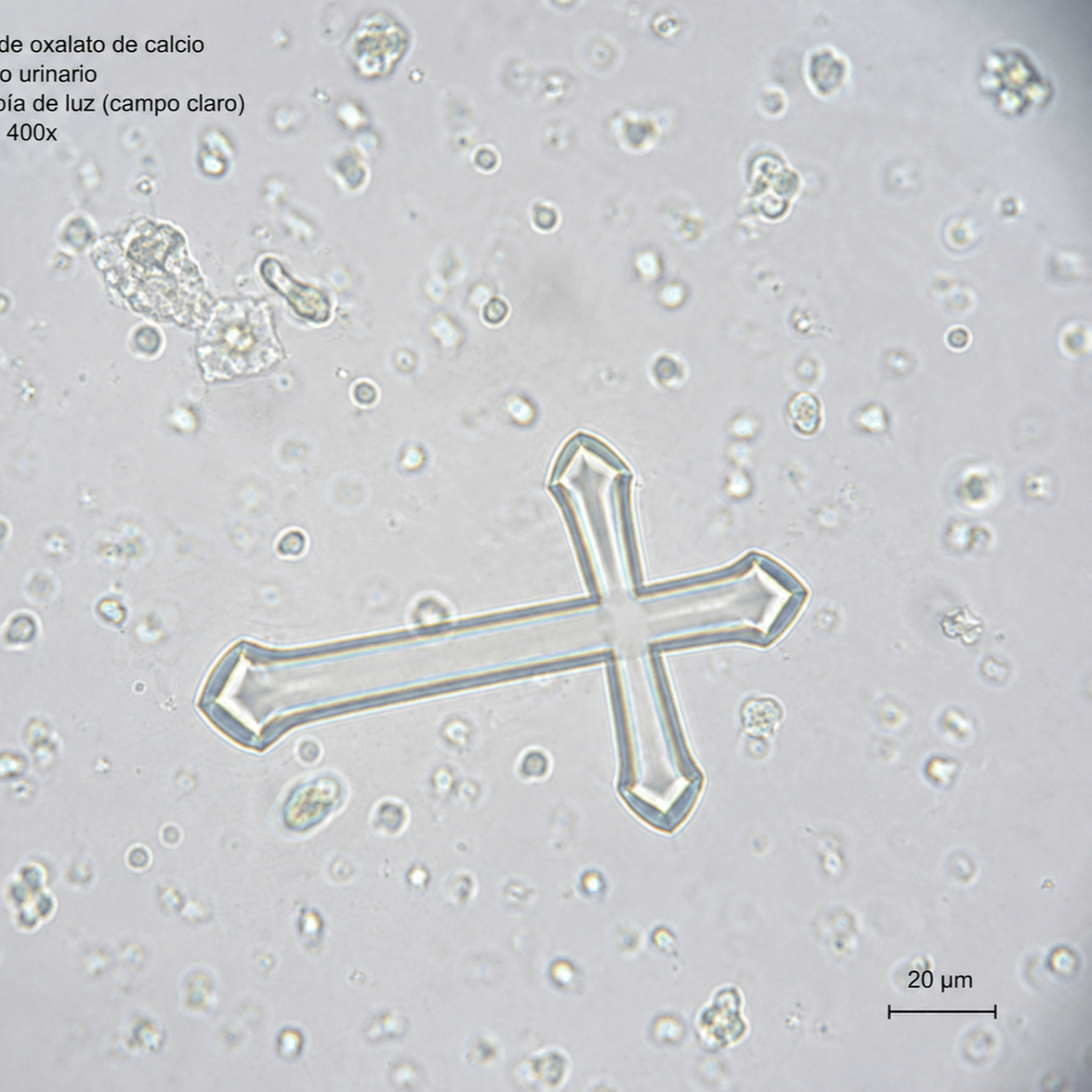 Microscopia de luz con cristales de oxalato de calcio en forma de cruz en sedimento urinario de una paciente con piedras renales