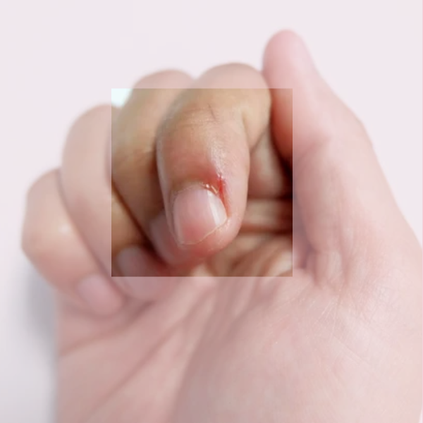 Hangnails: What Causes Them and How to Prevent Them