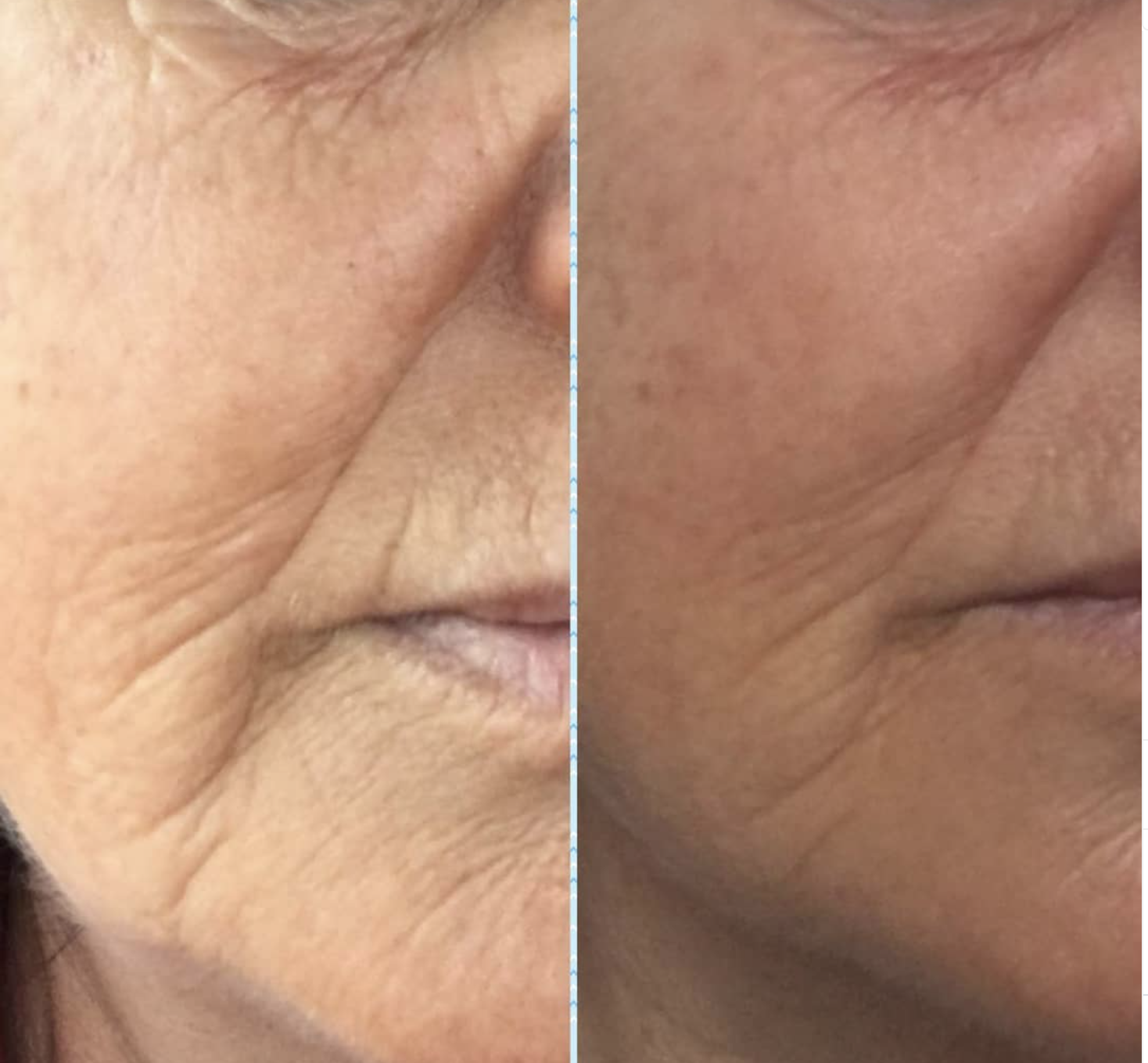 Close-up comparison of skin, showing reduction in wrinkles and fine lines on the right side after skincare treatment.