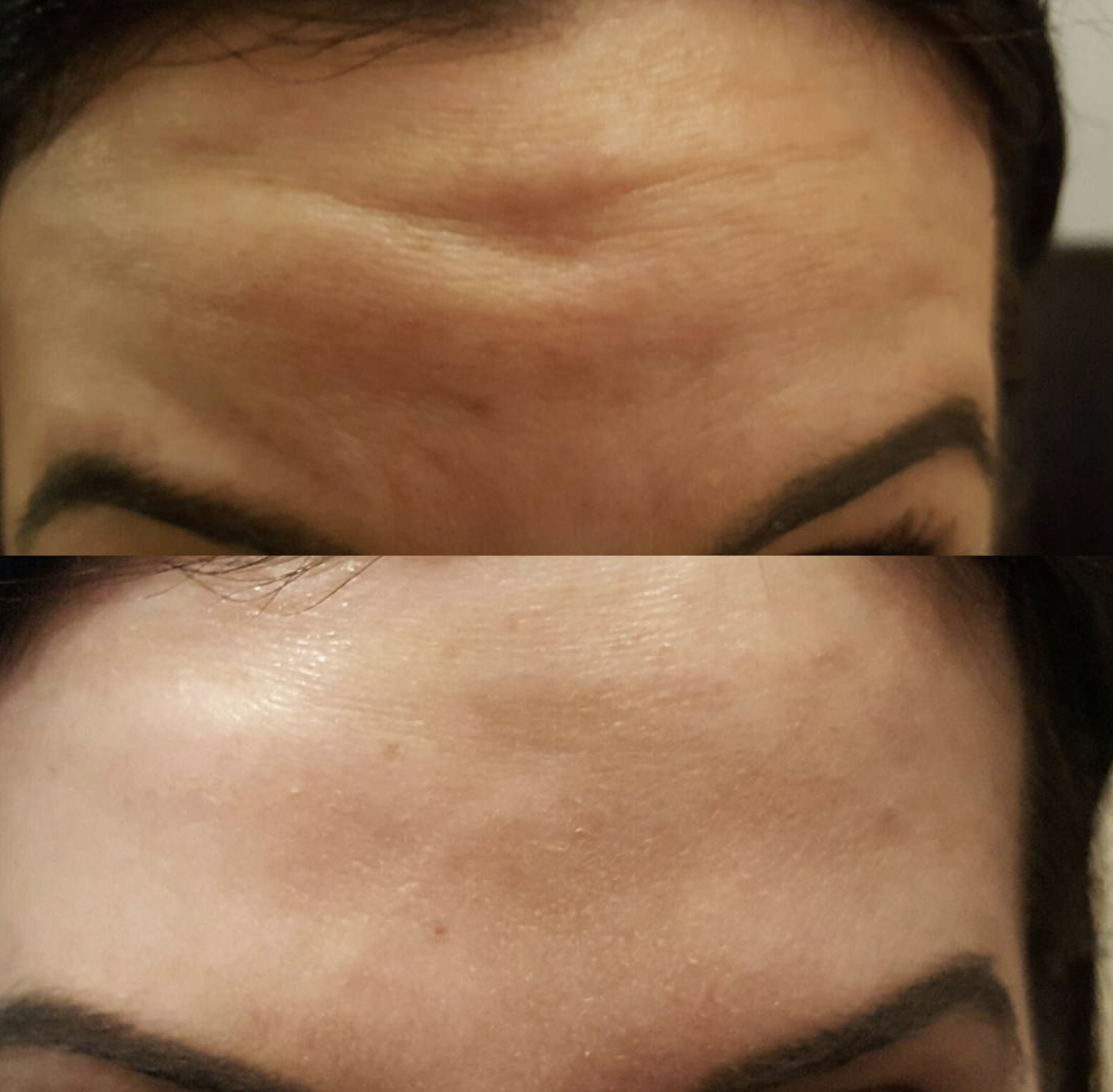 A comparison of a woman's forehead before and after skincare, showing reduced wrinkles and smoother skin.