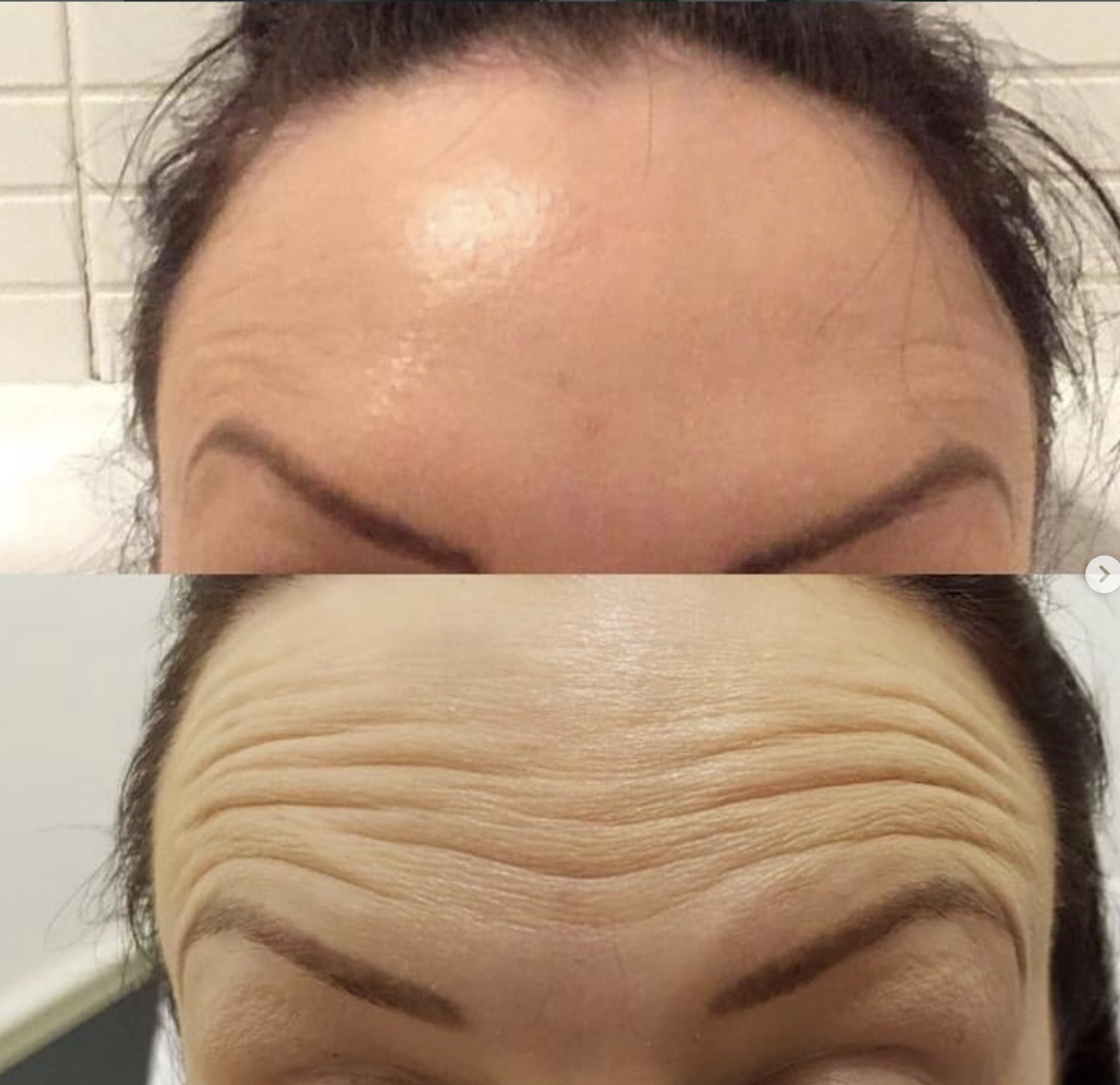 Comparison of a person's forehead; the top shows a smooth forehead, the bottom shows a wrinkled forehead with visible lines.