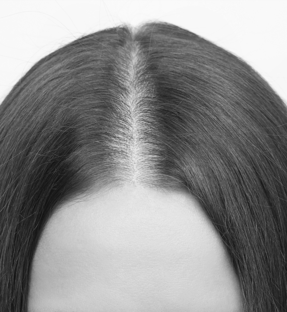 Alopécie androgénétique chez la femme