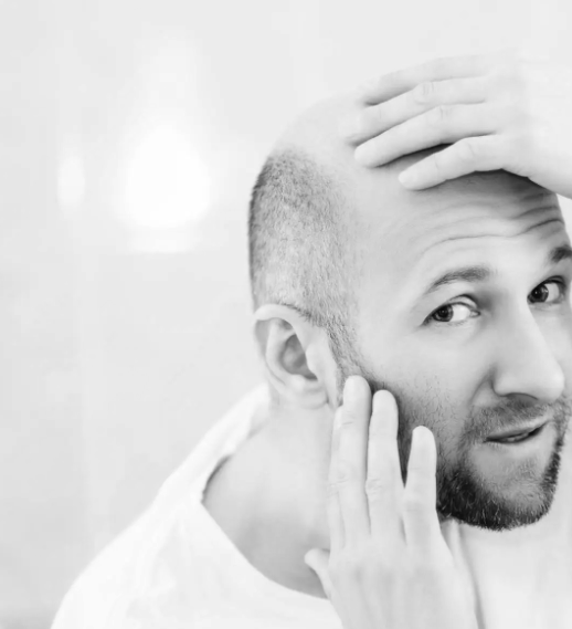 Calvitie homme, chute de cheveux homme