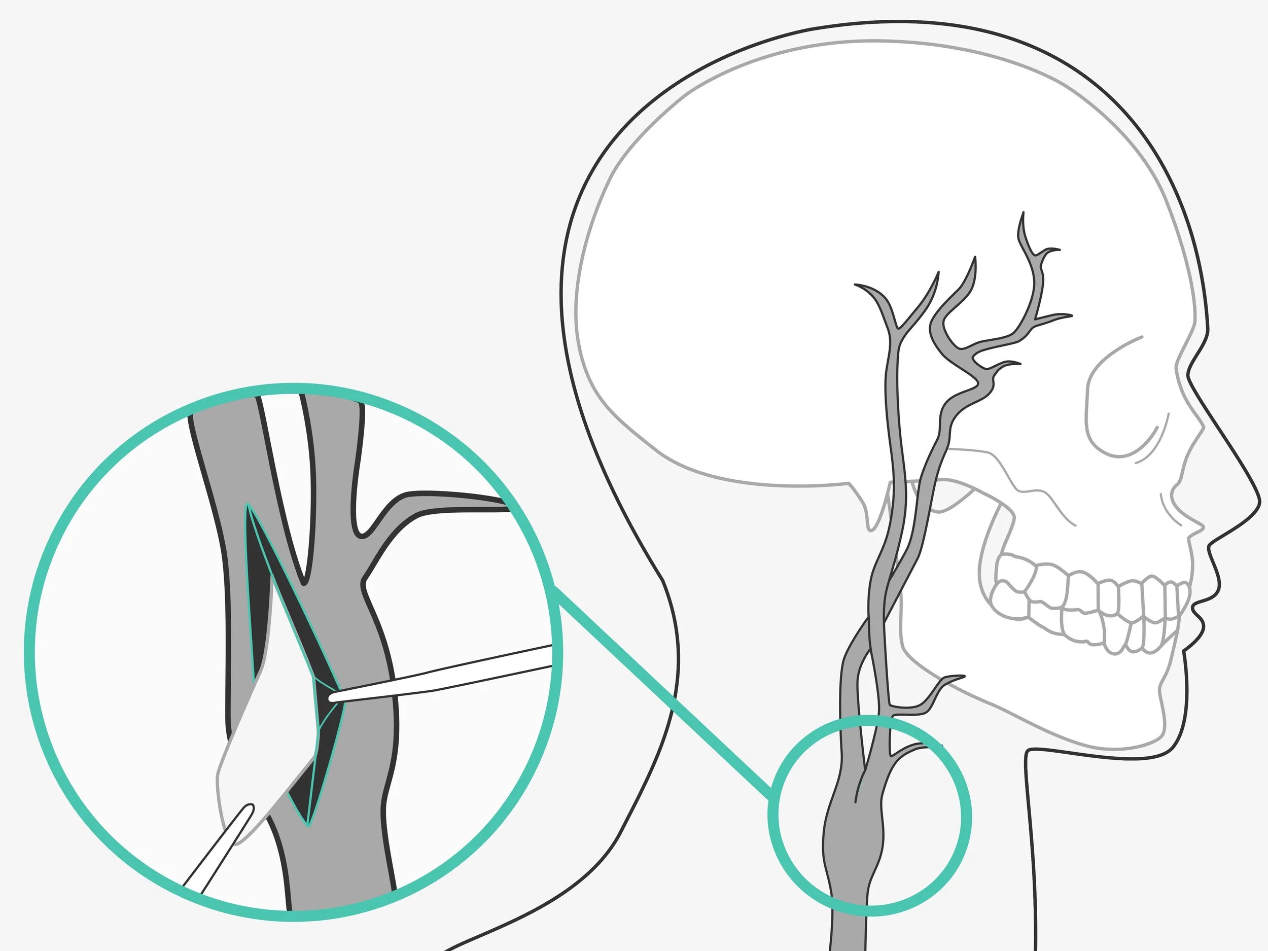 Vascular Surgery illustration