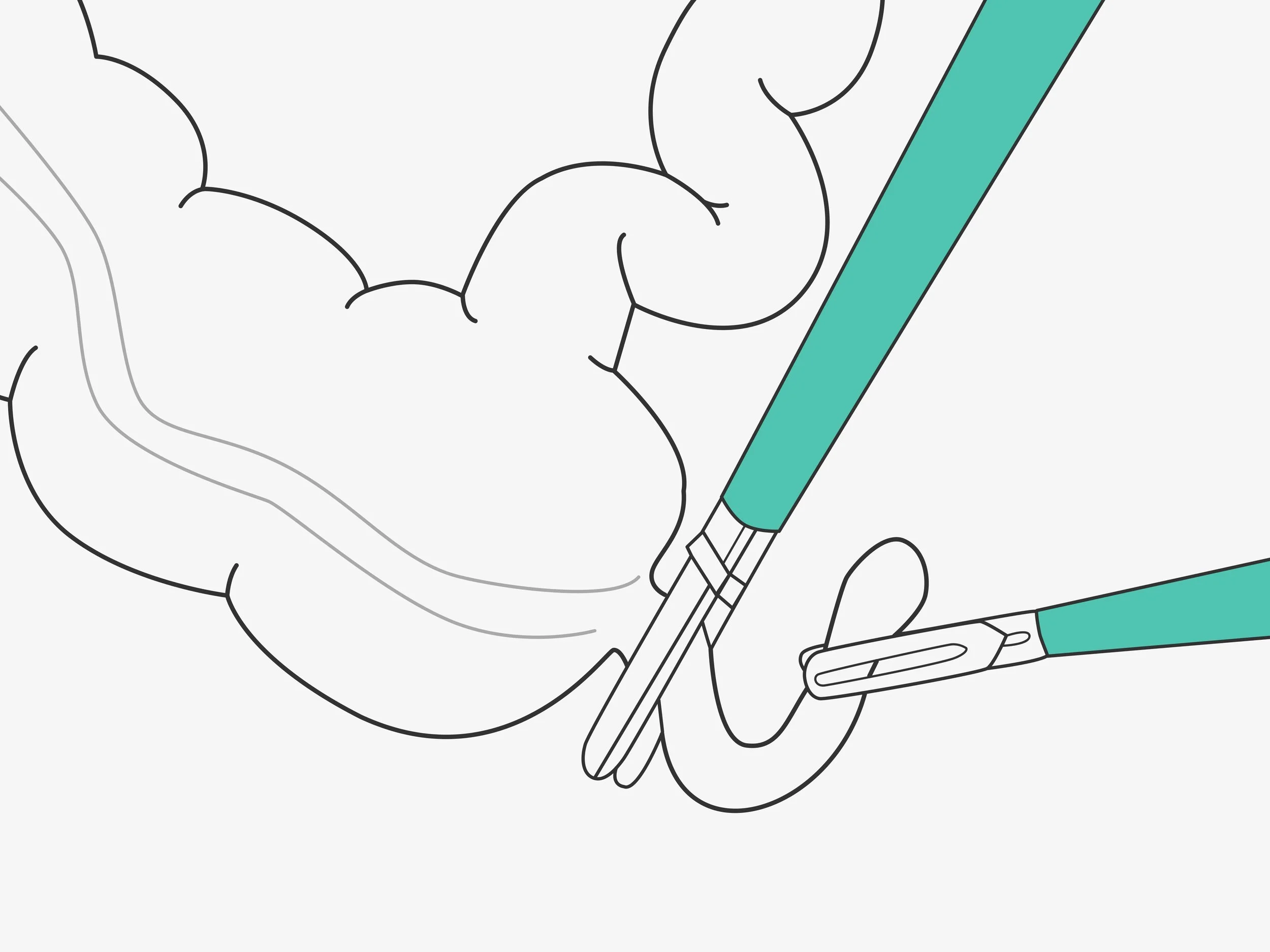 Laparoscopic Surgery Illustration