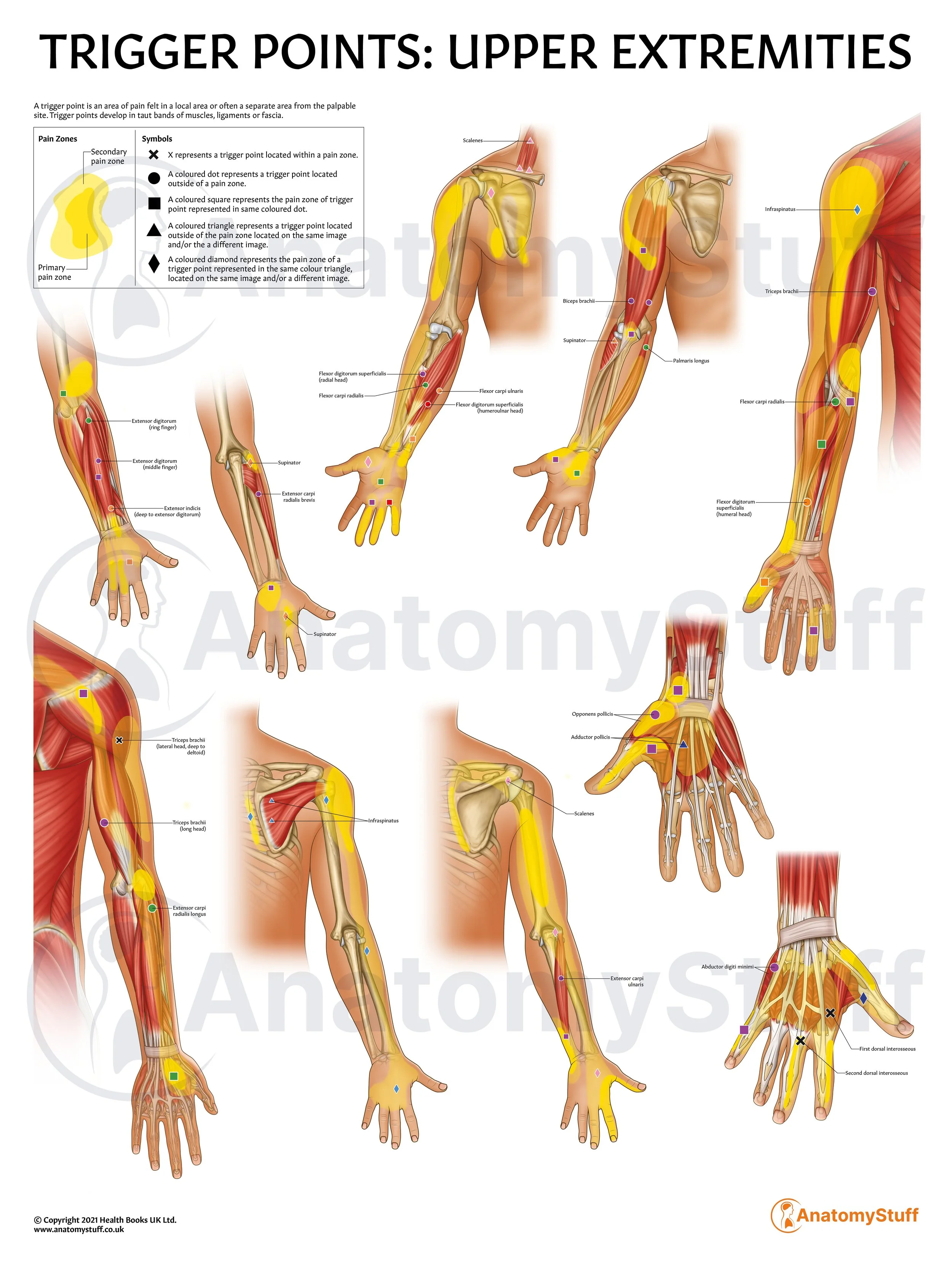 Trigger Points: Upper Extremities