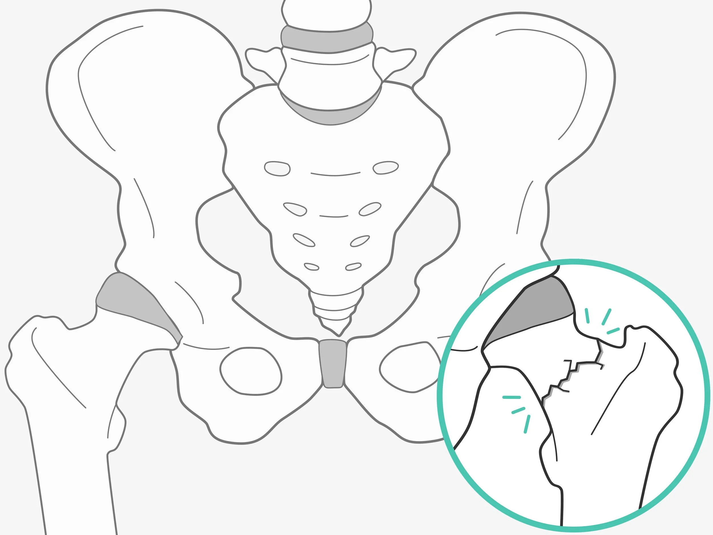 Hip Fracture - Orthopaedic illustration