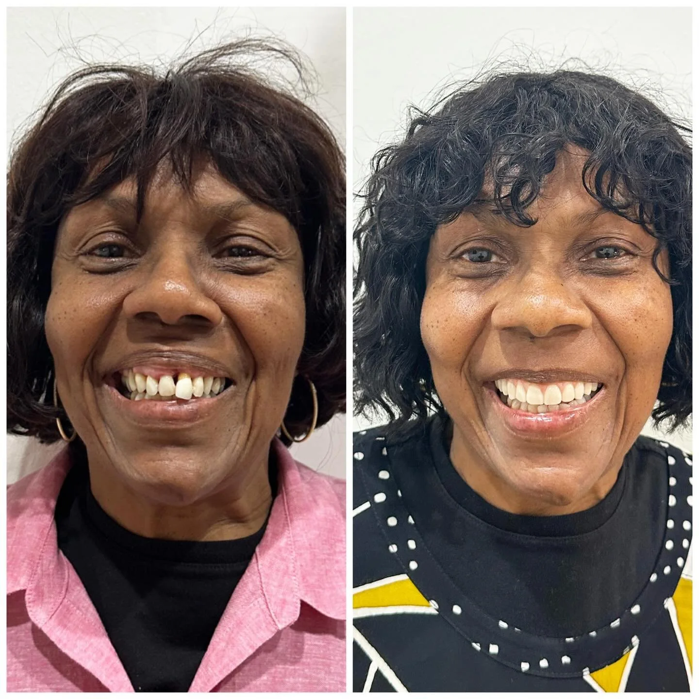 Restored confidence. Renewed joy. This is the power of dentistry done right.

#fullarch #photogrammetry #digitalfullarch #beforeandafter #dentalimplant