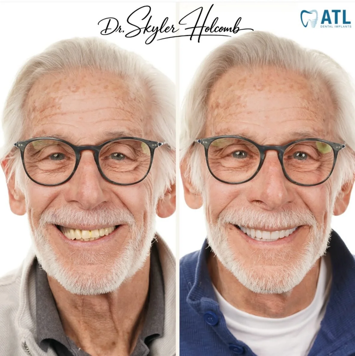 Full-arch before &amp; after. Fully digital. Perfect alignment. No occlusal adjustments needed.

📸: @drskylerholcomb