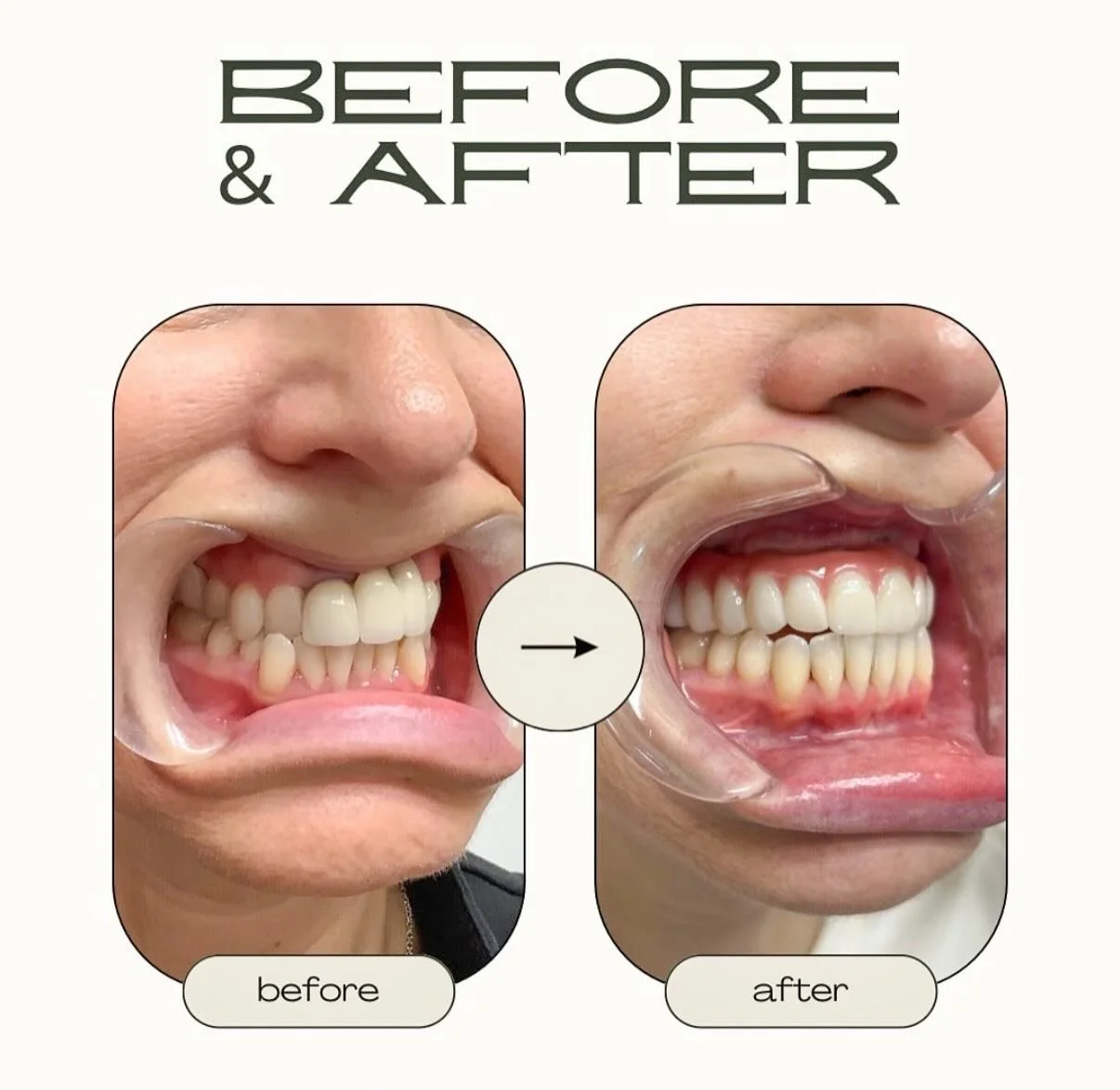 Before and after: Maxillary Hybrid Bridge restoration.

From compromised dentition to a fully restored maxillary arch, this case highlights the power of full-arch rehabilitation to deliver exceptional esthetics, function, and patient satisfaction.

p