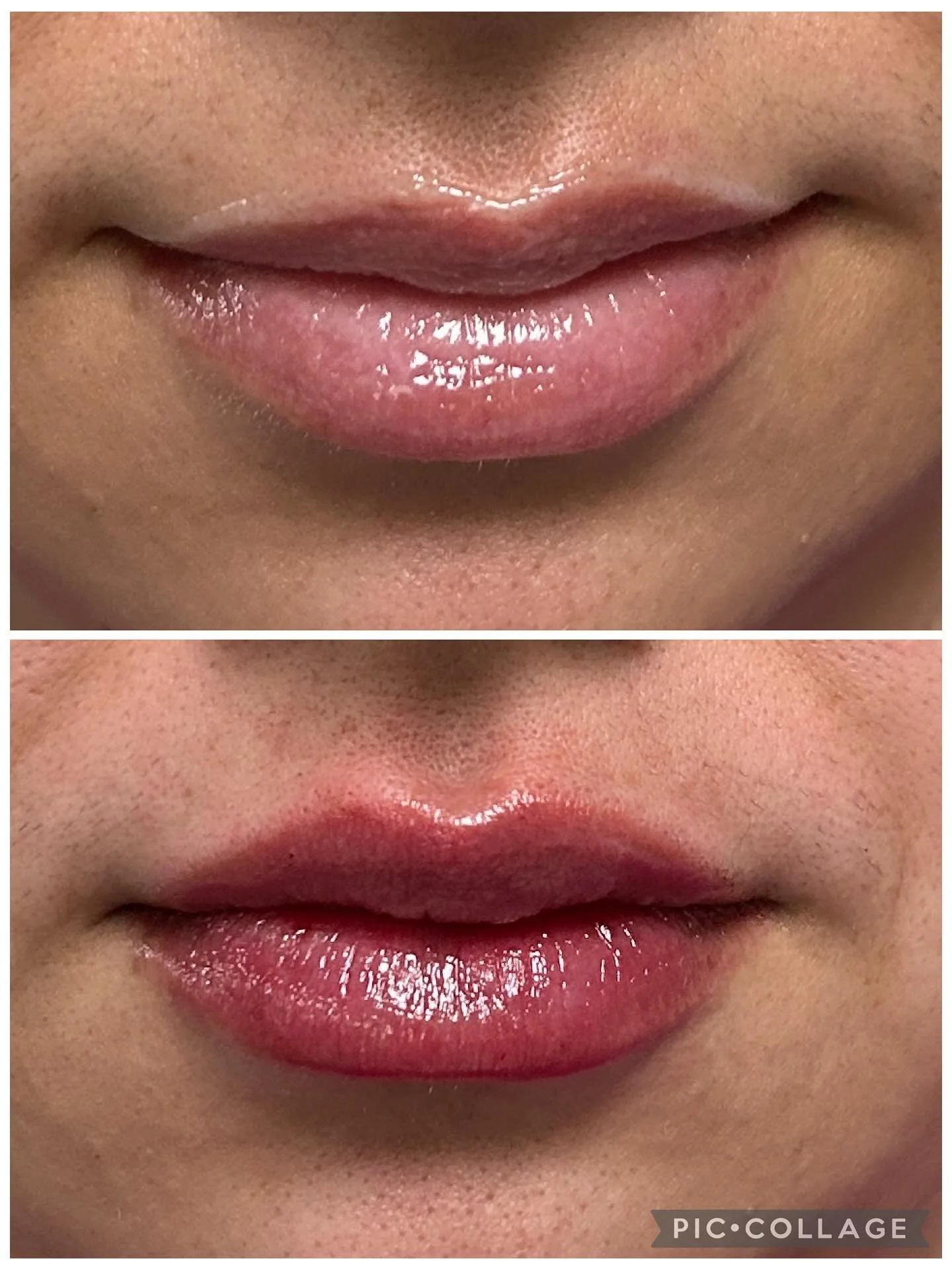 💉✨ Natural, but noticeable ✨💉

Our goal with lip filler isn&rsquo;t always bigger &mdash; it&rsquo;s better. 💋
This gorgeous transformation shows how a little bit of filler can:
✔️ Add subtle volume
✔️ Enhance natural shape
✔️ Define the borders
✔