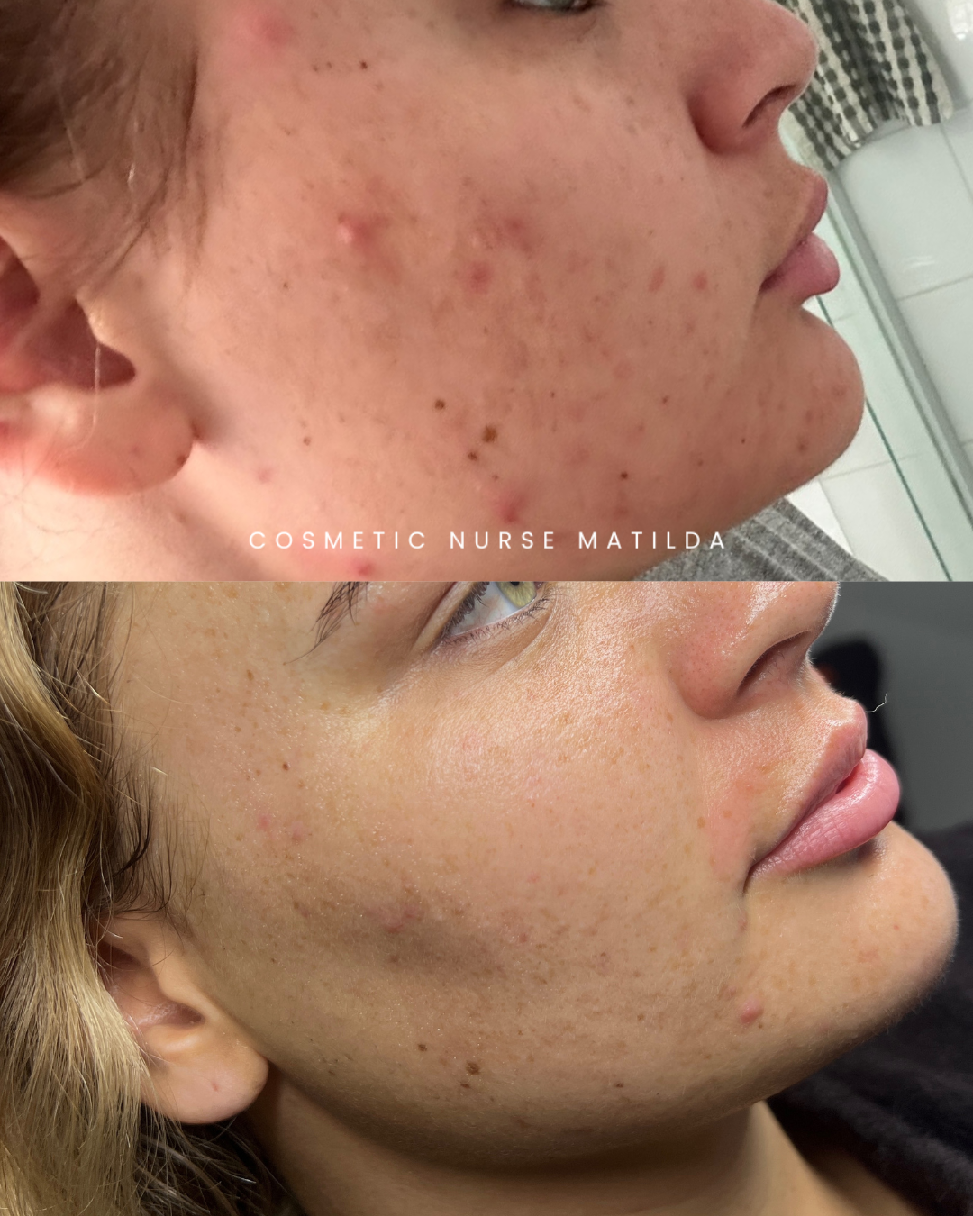 Acne Before and After-2.png