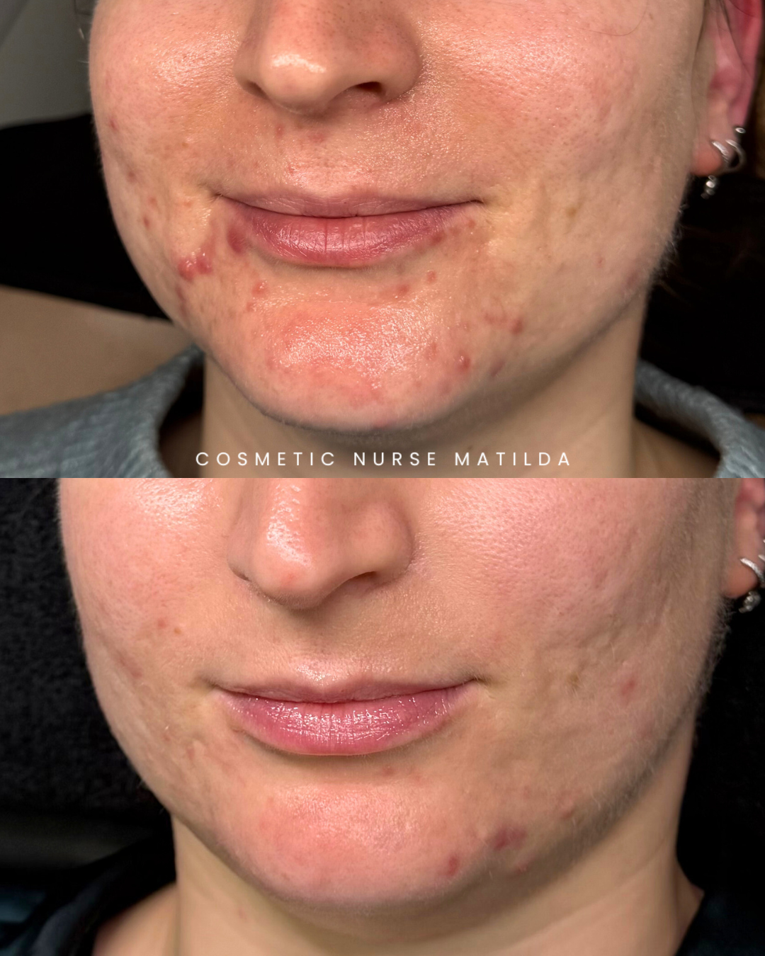 Acne Before and After.png