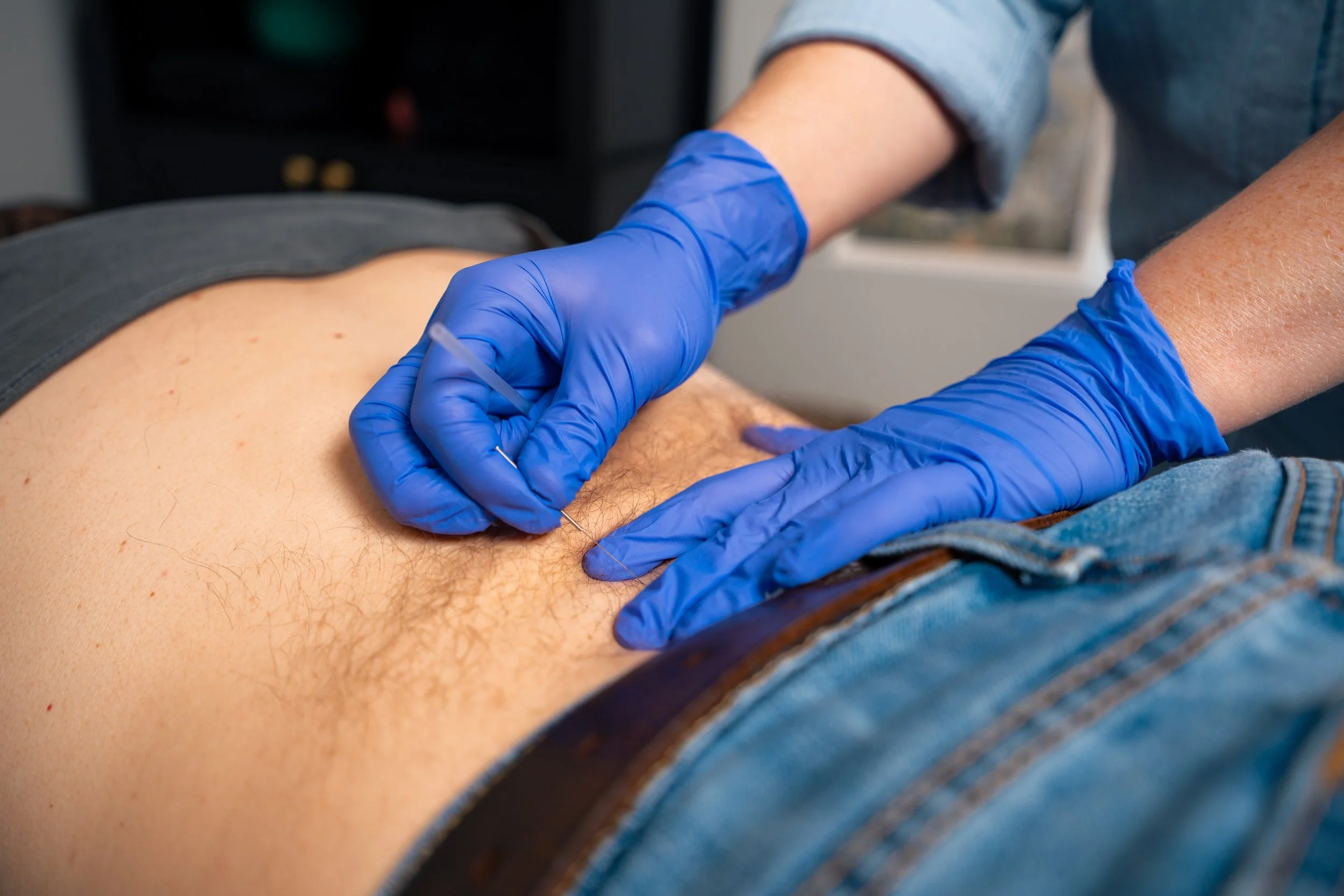 Dry Needling in Santa Rosa Beach, FL: How It Helps Relieve Chronic Pain, Tight Muscles &amp; Tension